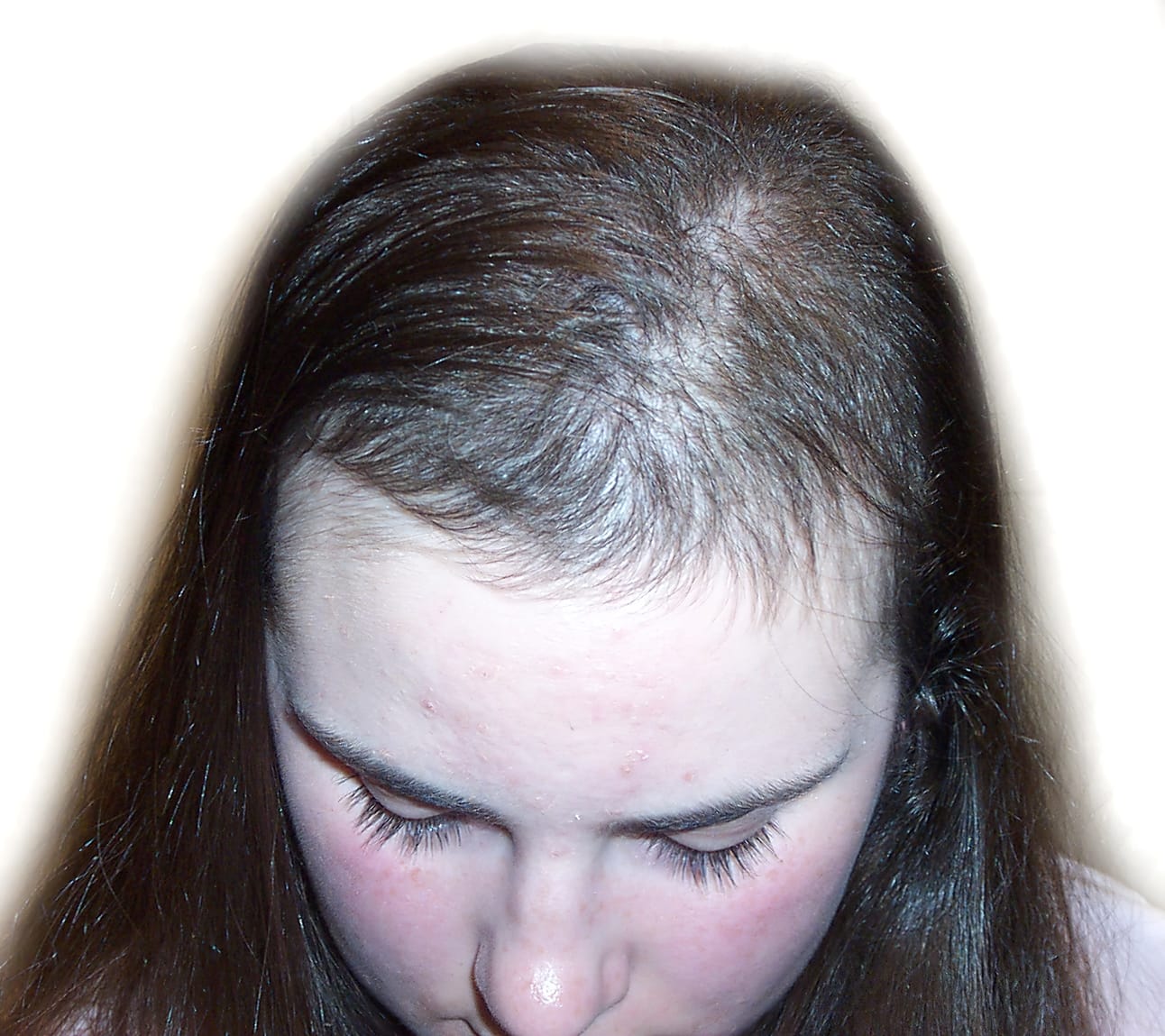 Before Picture - Trichotillomania Turnaround