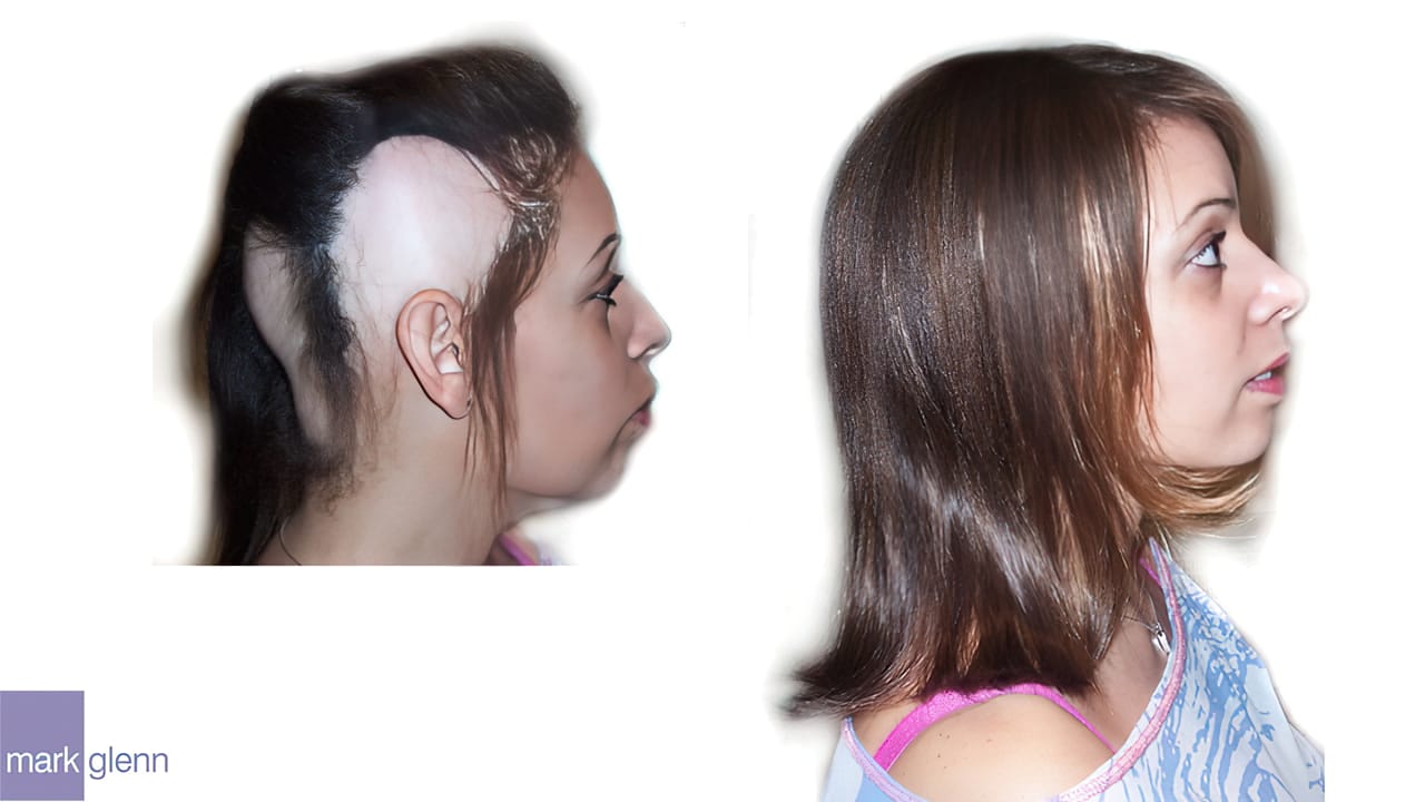 HL012 - Alopecia Areata - Cosmetic Solution from Mark Glenn, London, UK