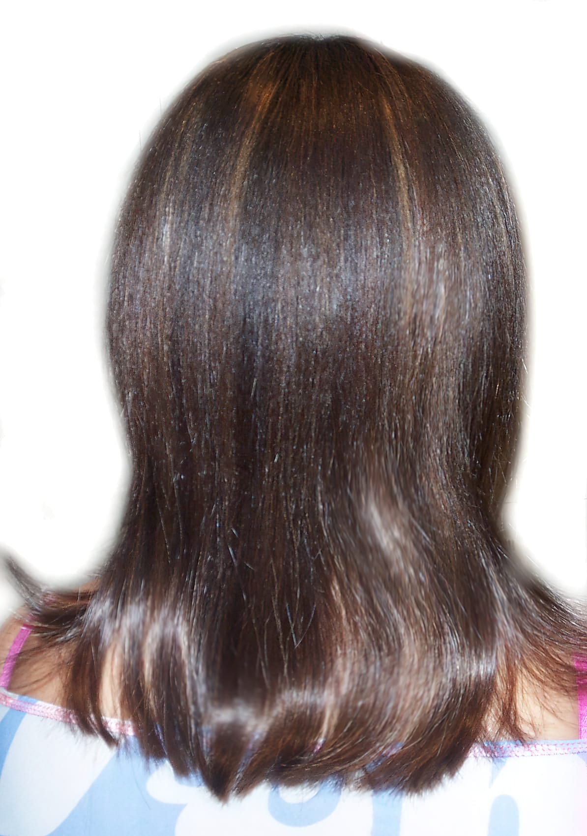 After Picture - Alopecia Areata
