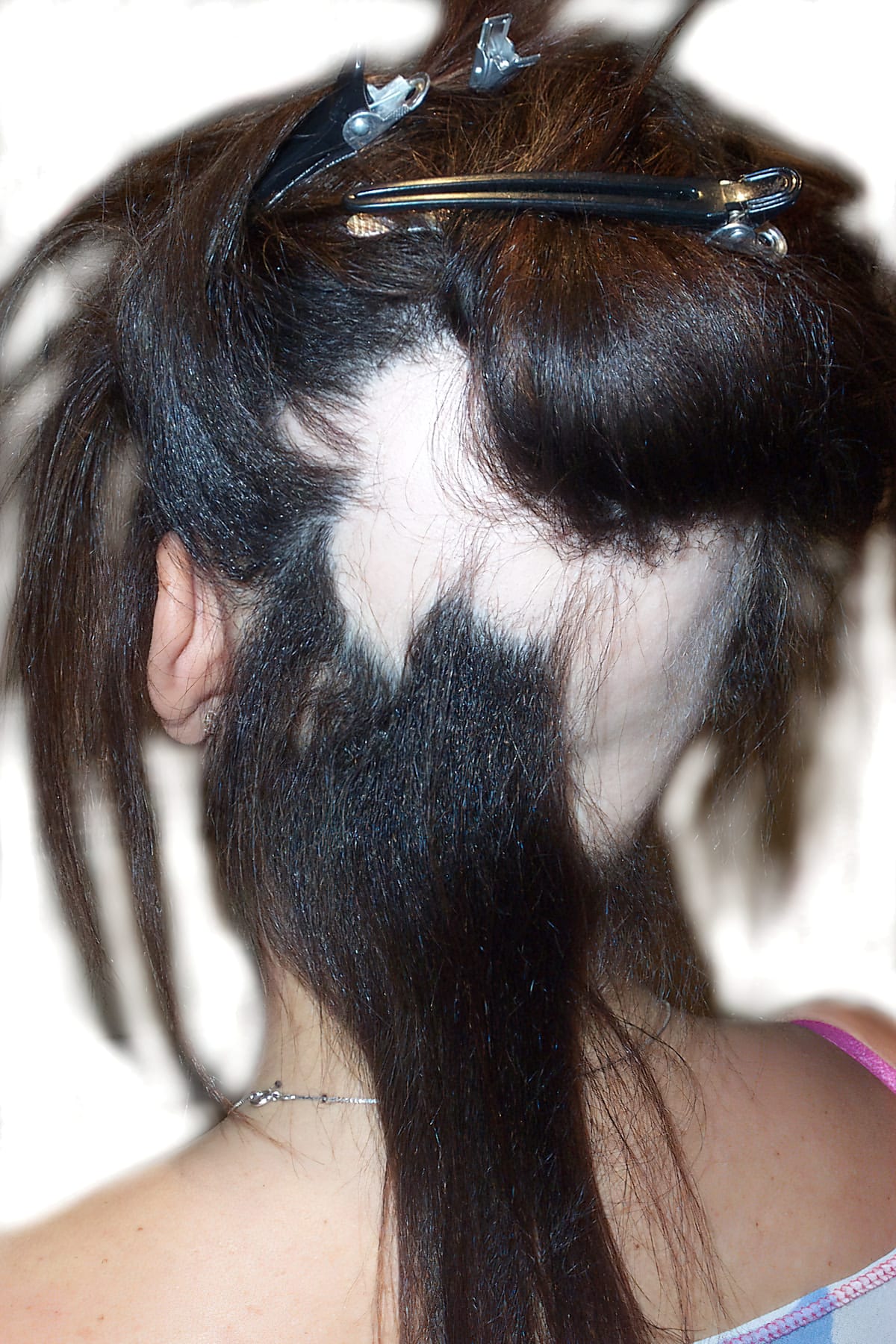 Before Picture - Alopecia Areata