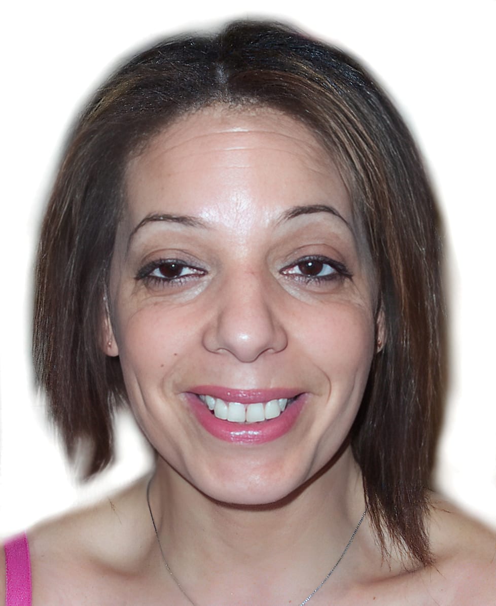 Before Picture - Alopecia Areata