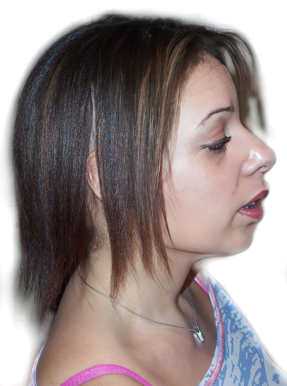 Before Picture - Alopecia Areata