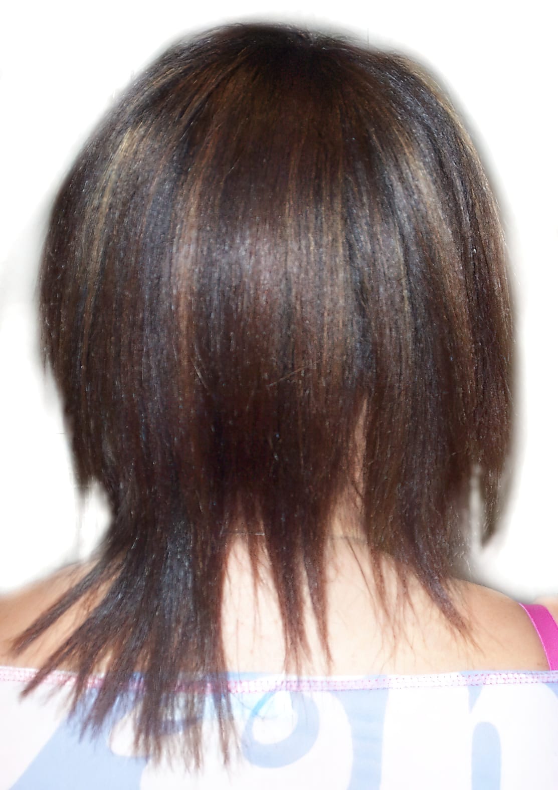 Before Picture - Alopecia Areata