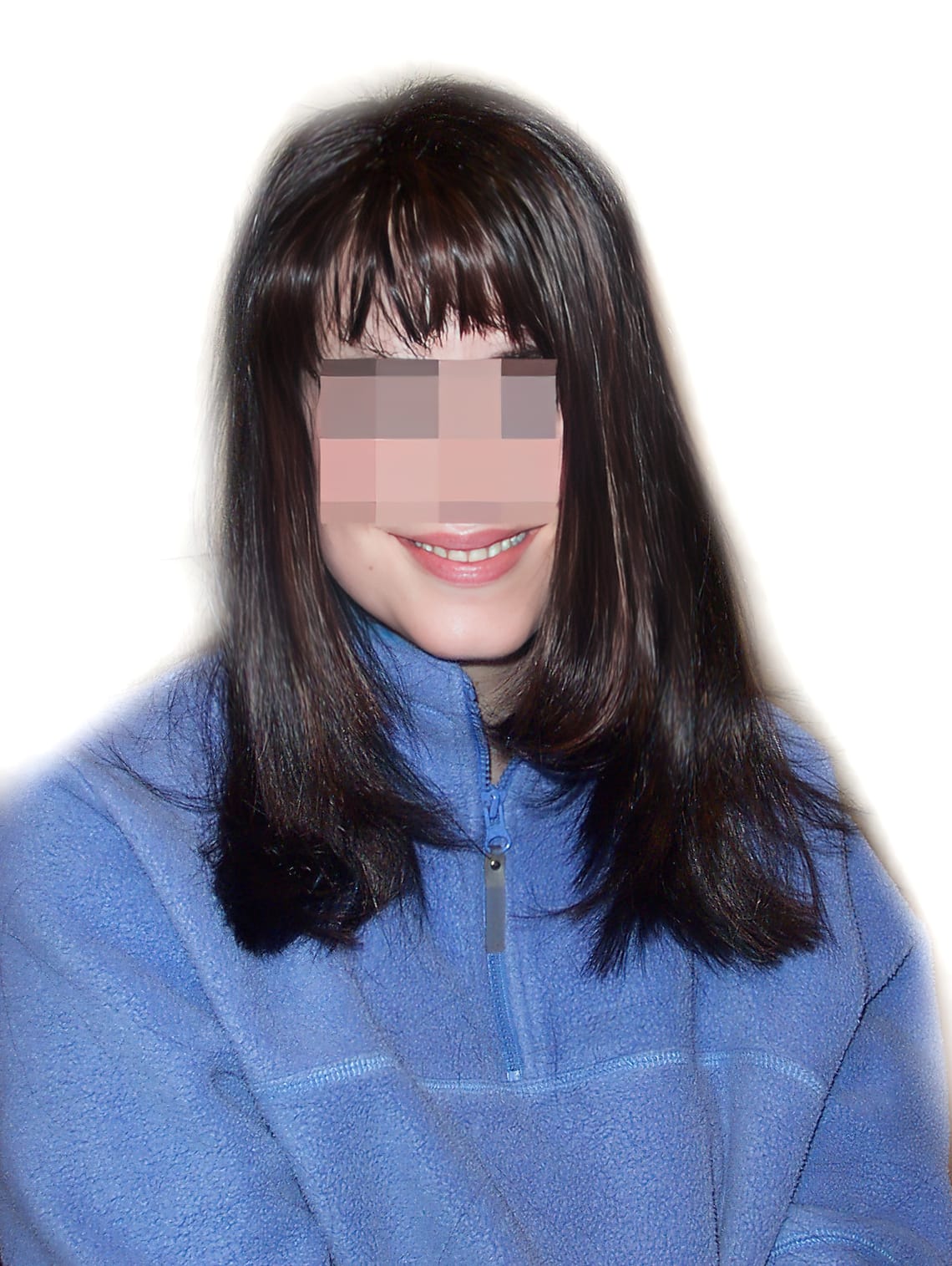 After Picture - Androgenetic Alopecia