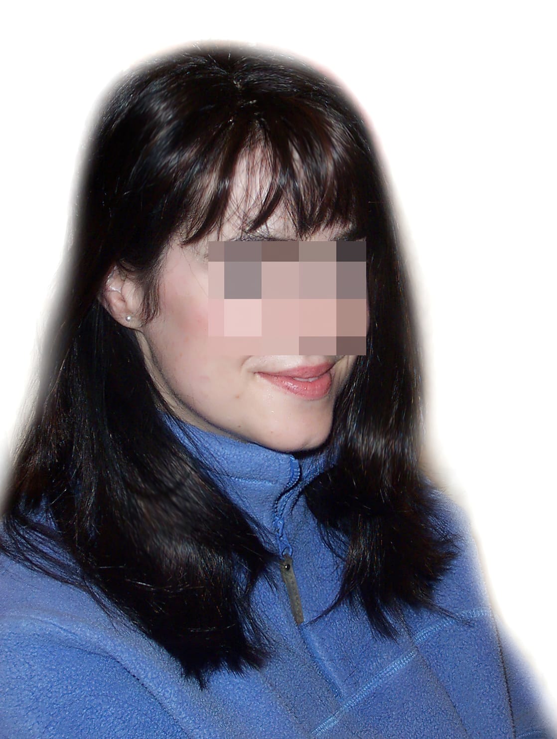 After Picture - Androgenetic Alopecia