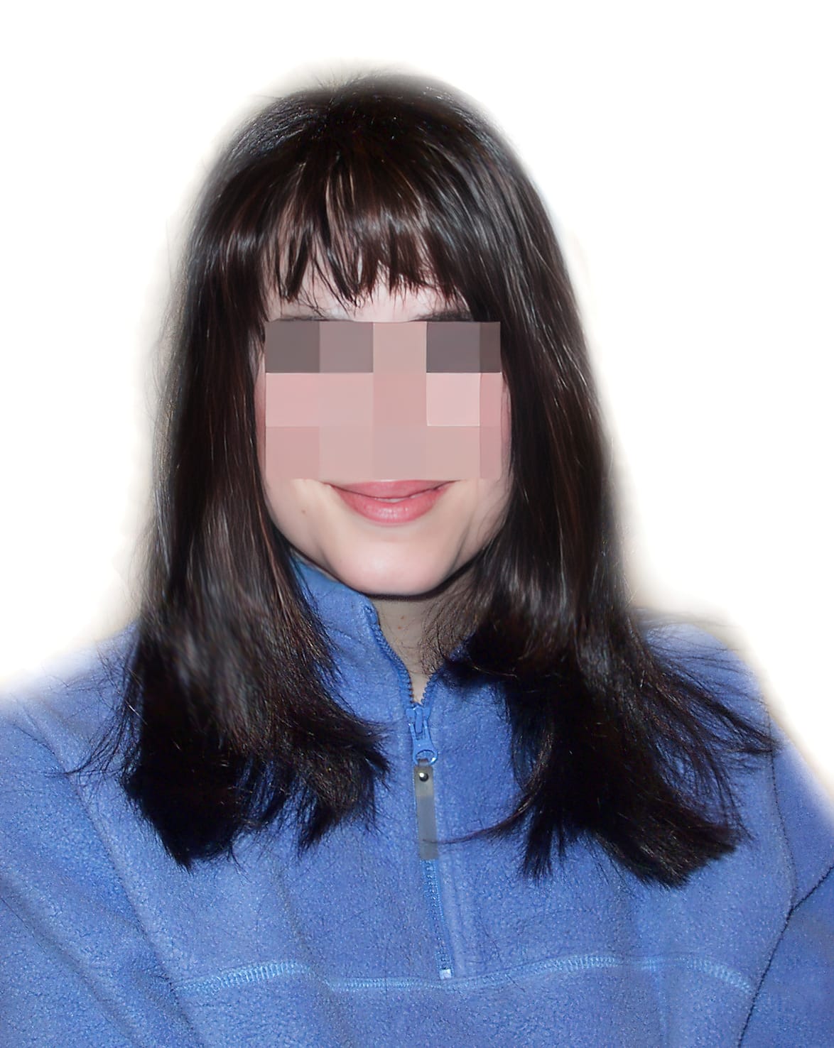 After Picture - Androgenetic Alopecia
