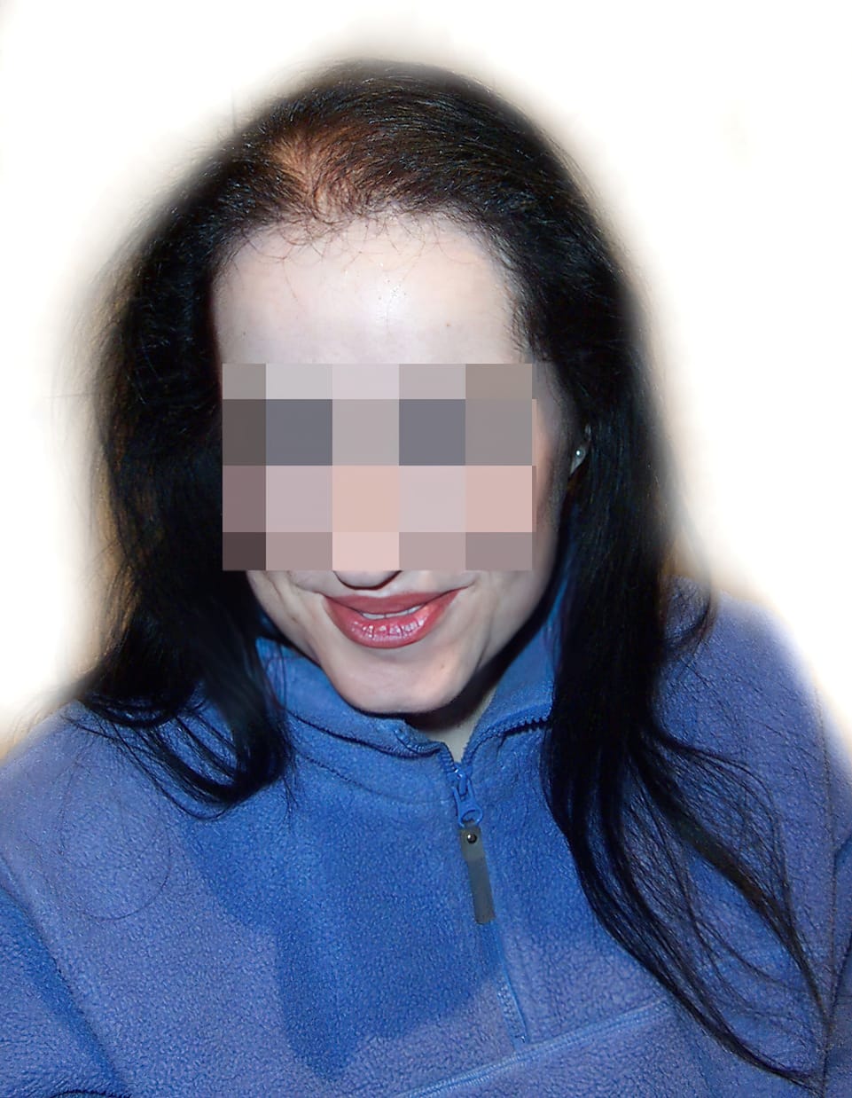 Before Picture - Androgenetic Alopecia