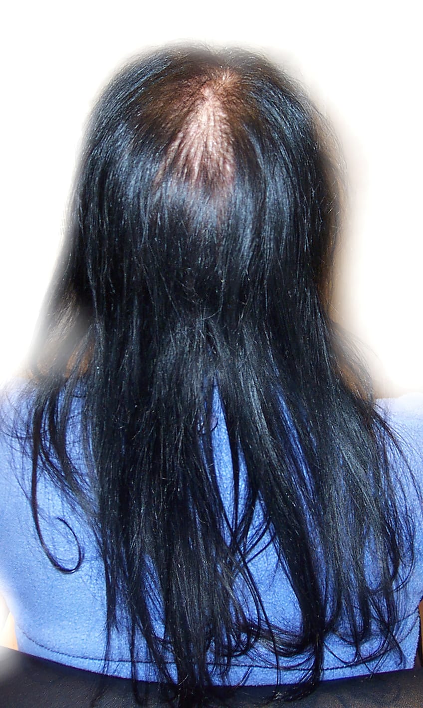 Before Picture - Androgenetic Alopecia