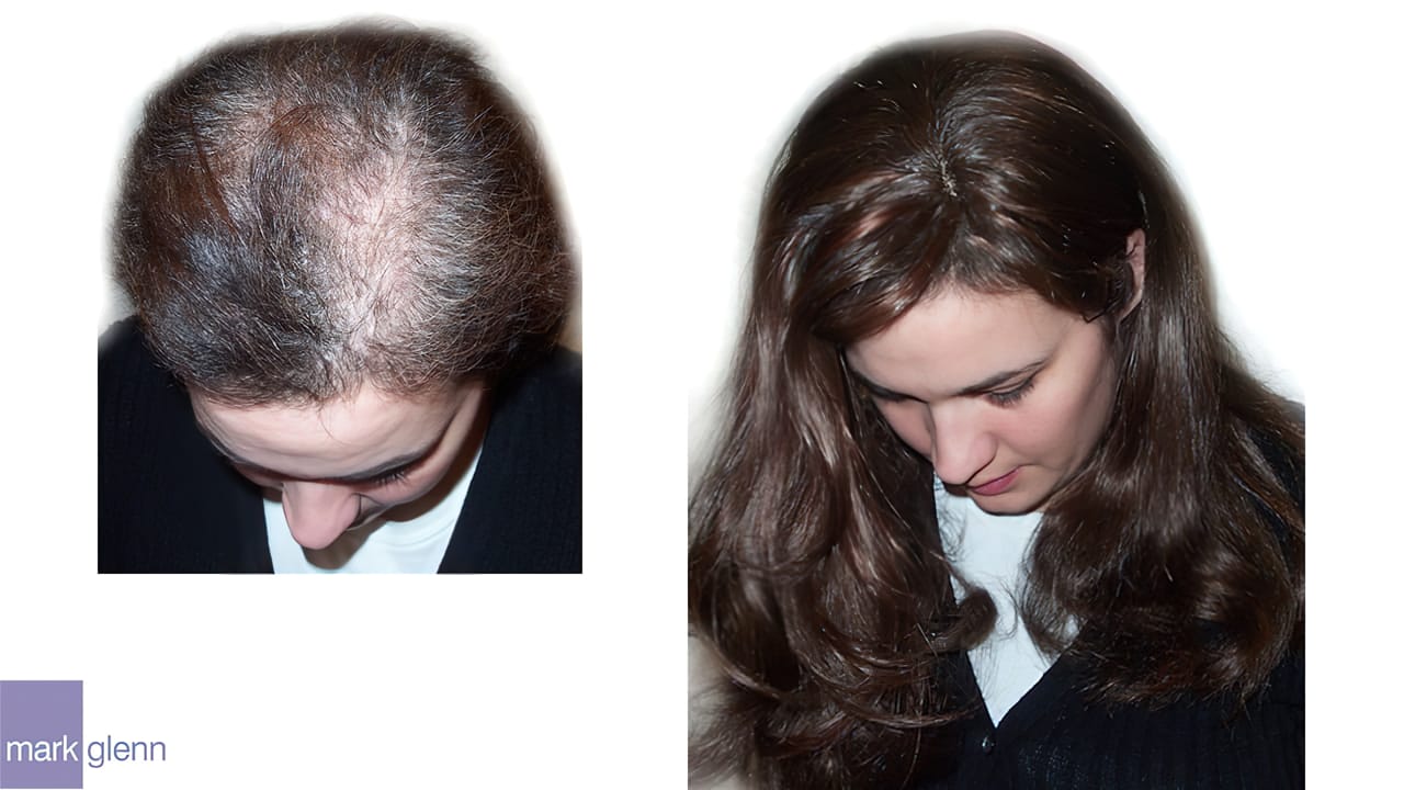 Trichotillomania Female Hair Loss Information Mark Glenn Hair