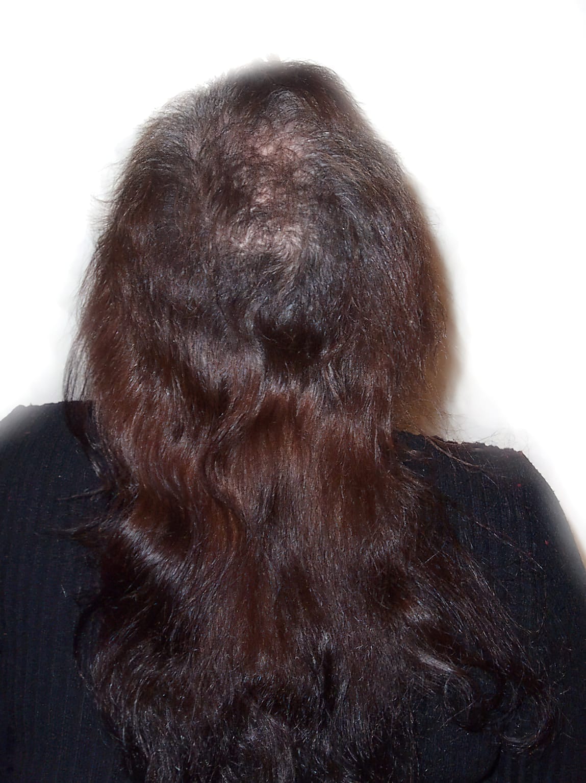 Before Picture - Trichotillomania Success - Now Pull-Free