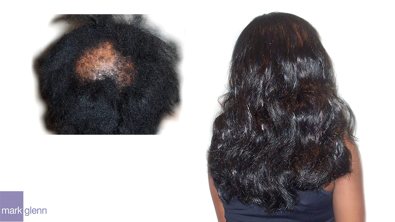 Traction Alopecia from Clip-In Hairpiece