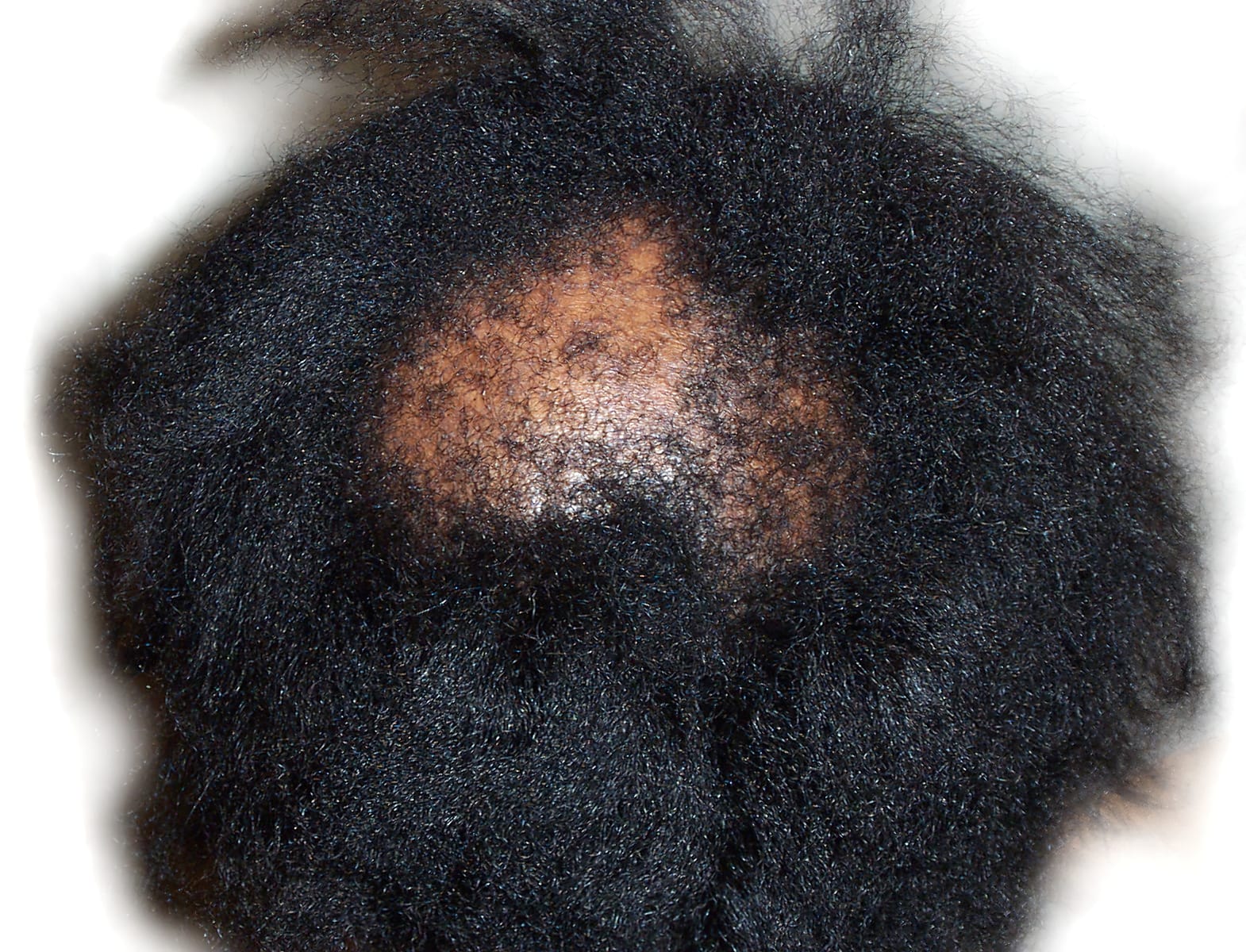 Before Picture - Traction Alopecia from Clip-In Hairpiece