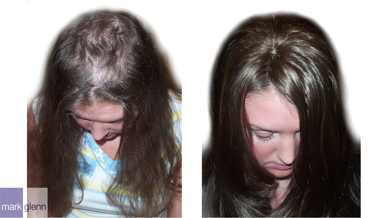 HL016 - Trichotillomania - Cosmetic Hair Solutions London