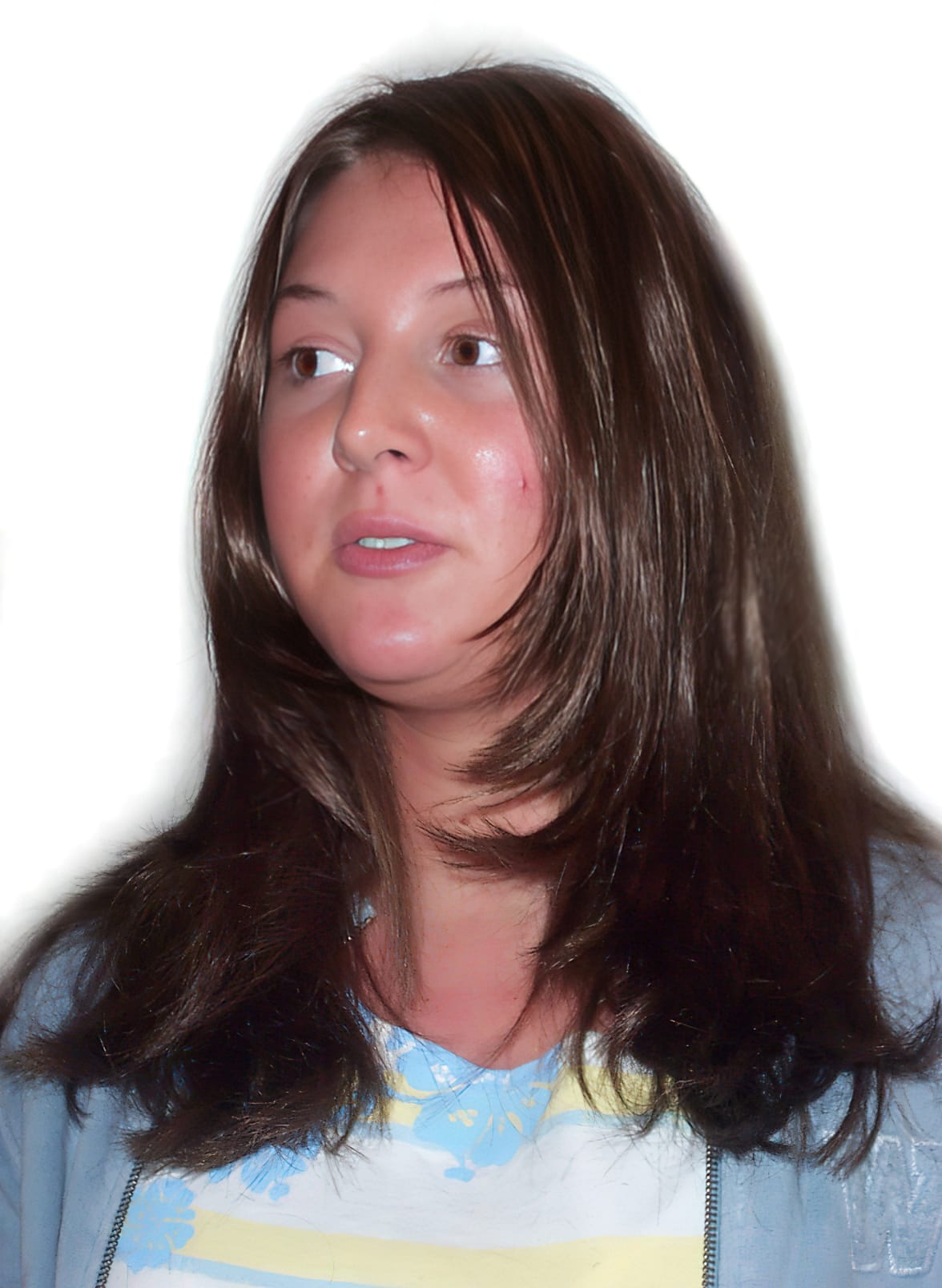 After Picture - Trichotillomania