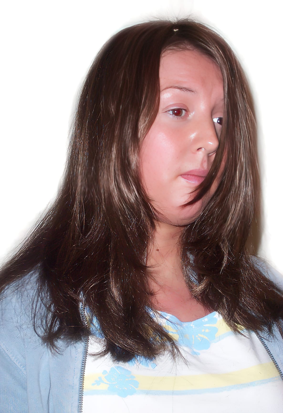 After Picture - Trichotillomania