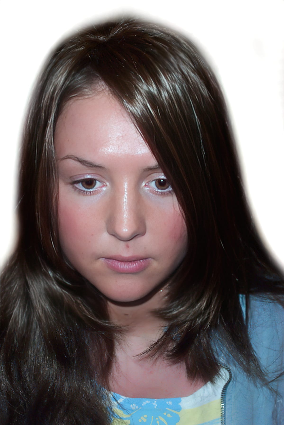 After Picture - Trichotillomania