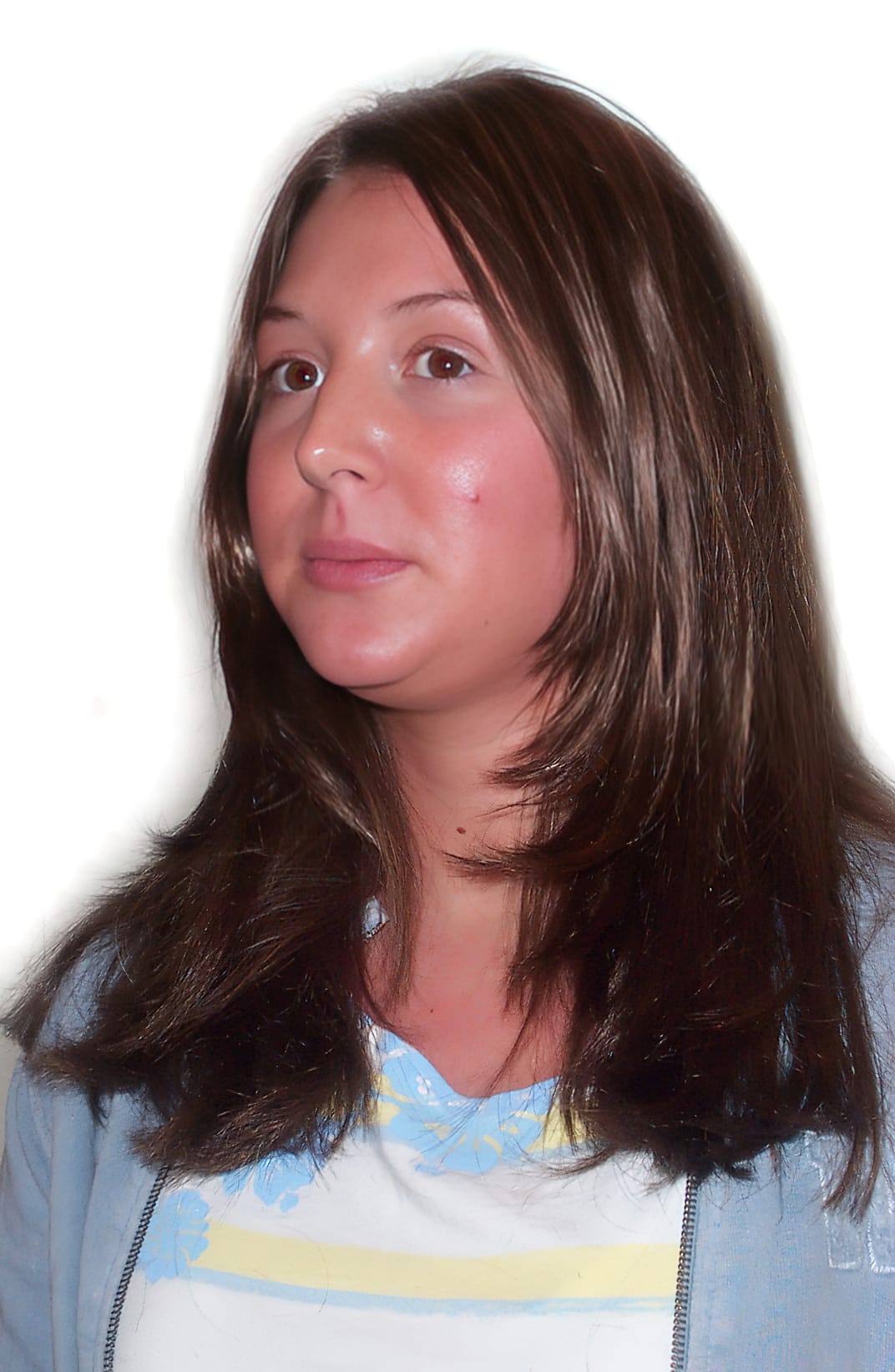 After Picture - Trichotillomania