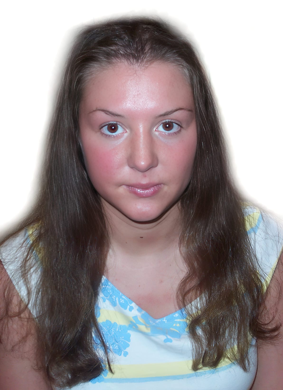 Before Picture - Trichotillomania