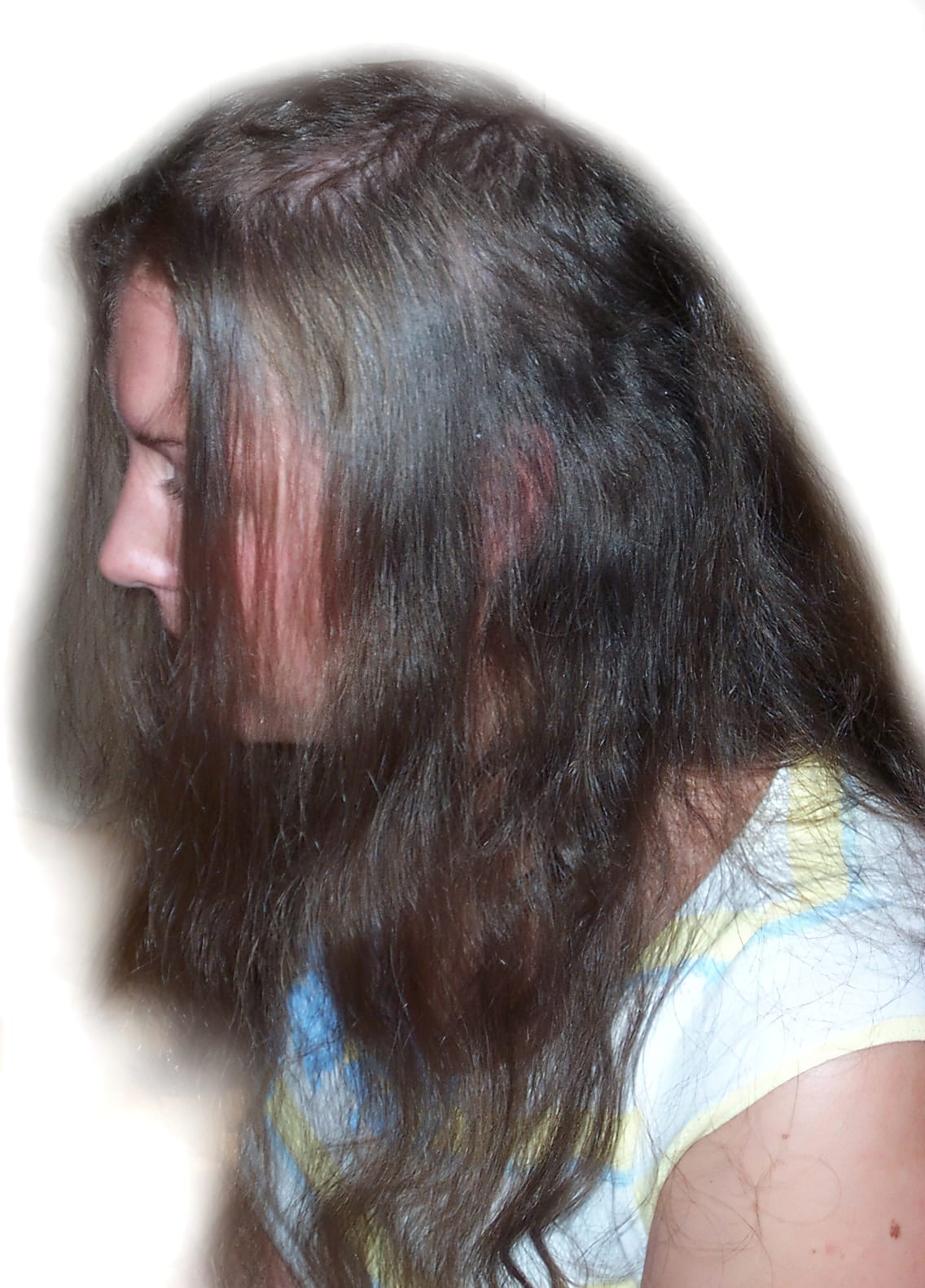 Before Picture - Trichotillomania
