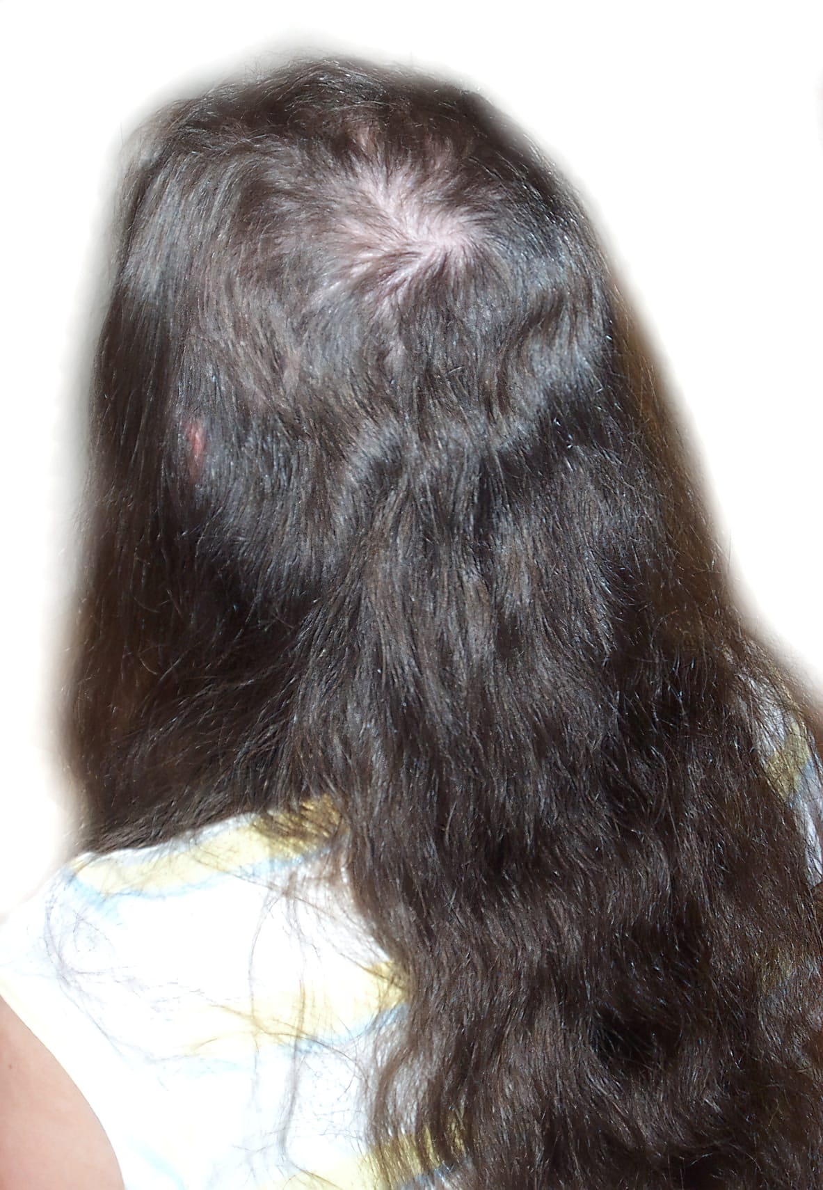 Before Picture - Trichotillomania