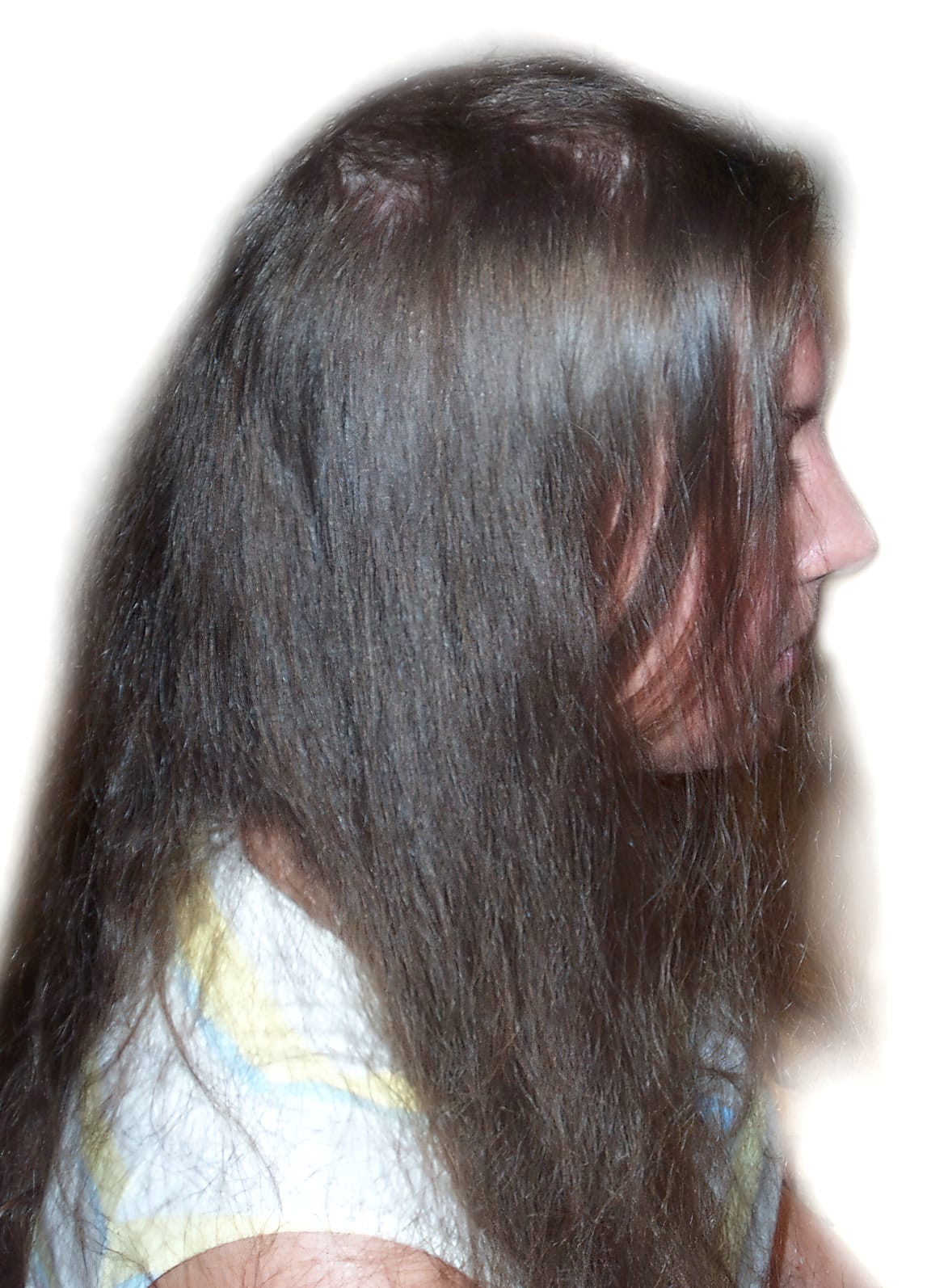 Before Picture - Trichotillomania