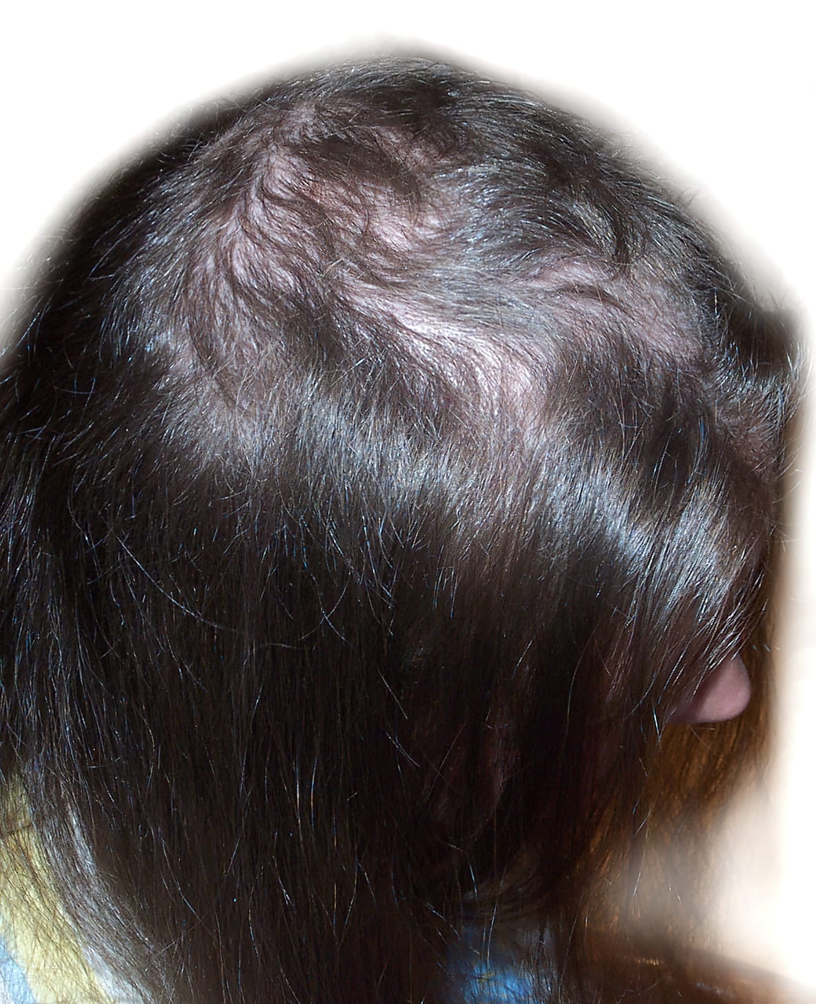 Before Picture - Trichotillomania
