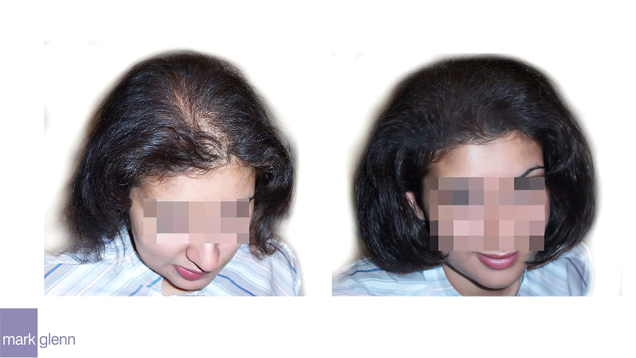 Androgenetic Alopecia / Stress