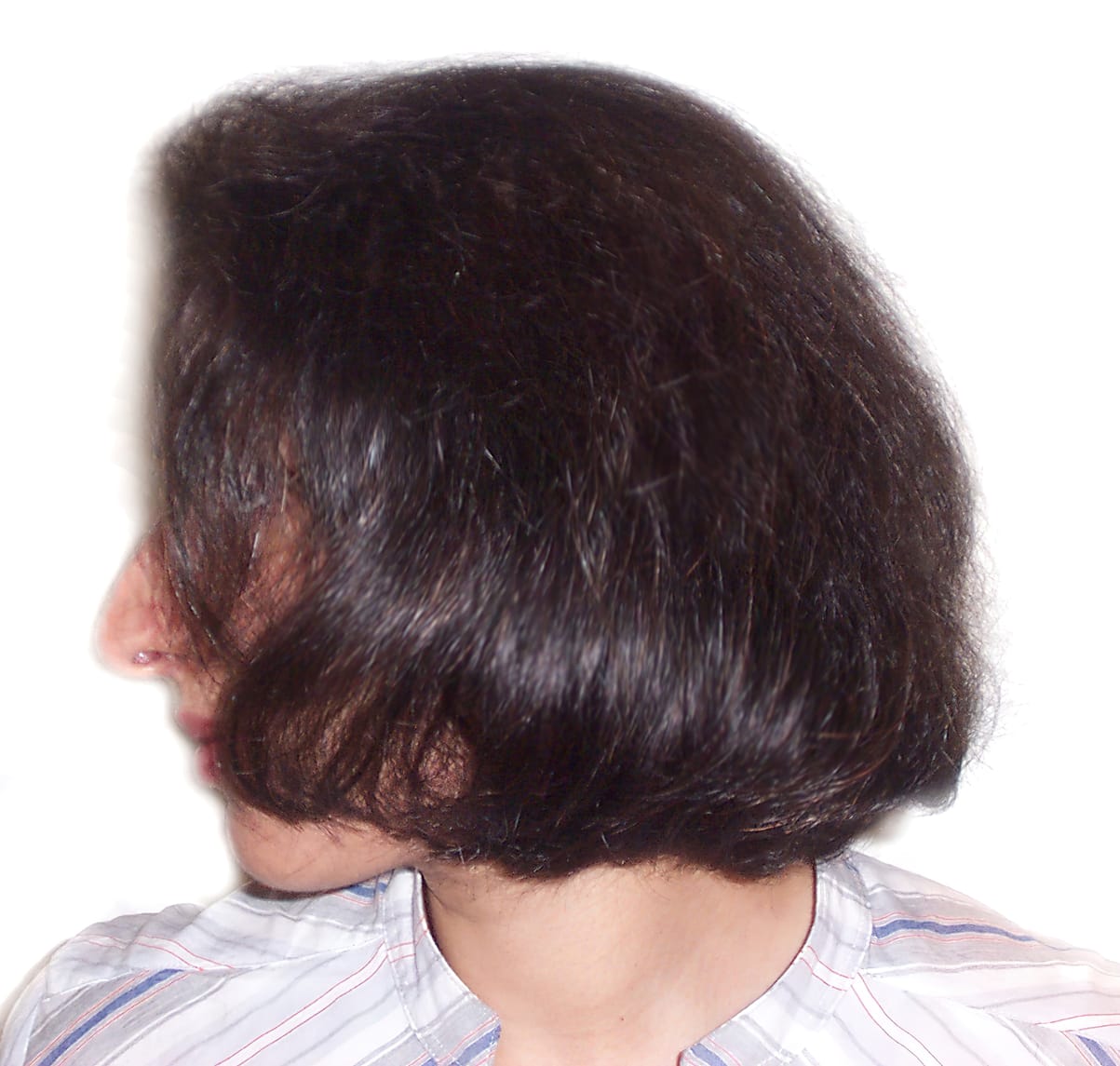 After Picture - Androgenetic Alopecia / Stress
