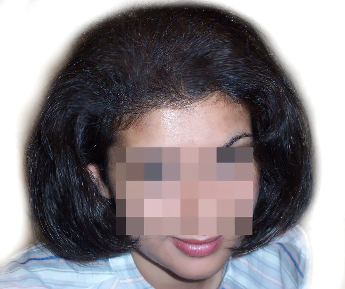 After Picture - Androgenetic Alopecia / Stress
