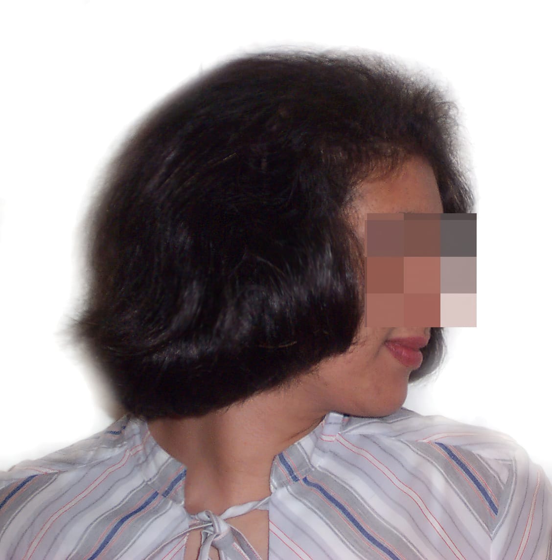 After Picture - Androgenetic Alopecia / Stress