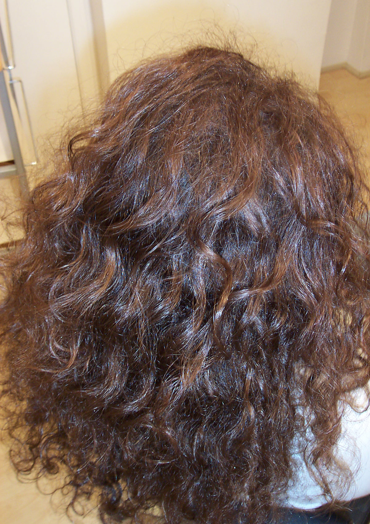 After Picture - Temporary Hormonal Alopecia Sorted
