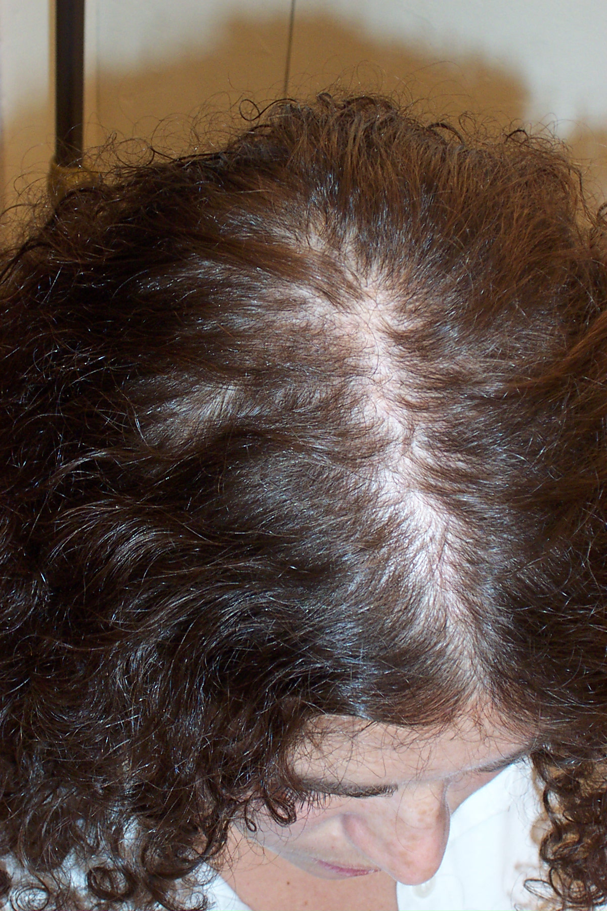 Before Picture - Temporary Hormonal Alopecia Sorted