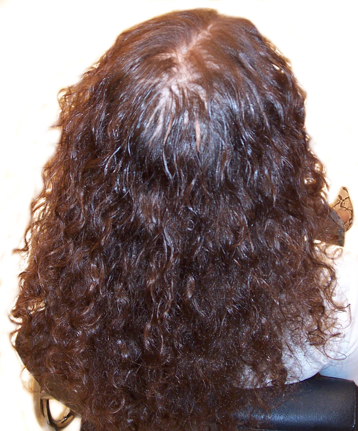 Before Picture - Temporary Hormonal Alopecia Sorted