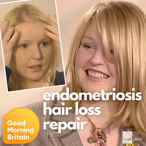 HL100-M - TV Feature - Endometriosis Hair Loss Miracle Makeover - Before & After