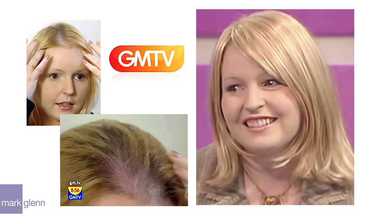 HL100-M - TV Feature - Endometriosis Hair Loss Miracle Makeover - Before & After