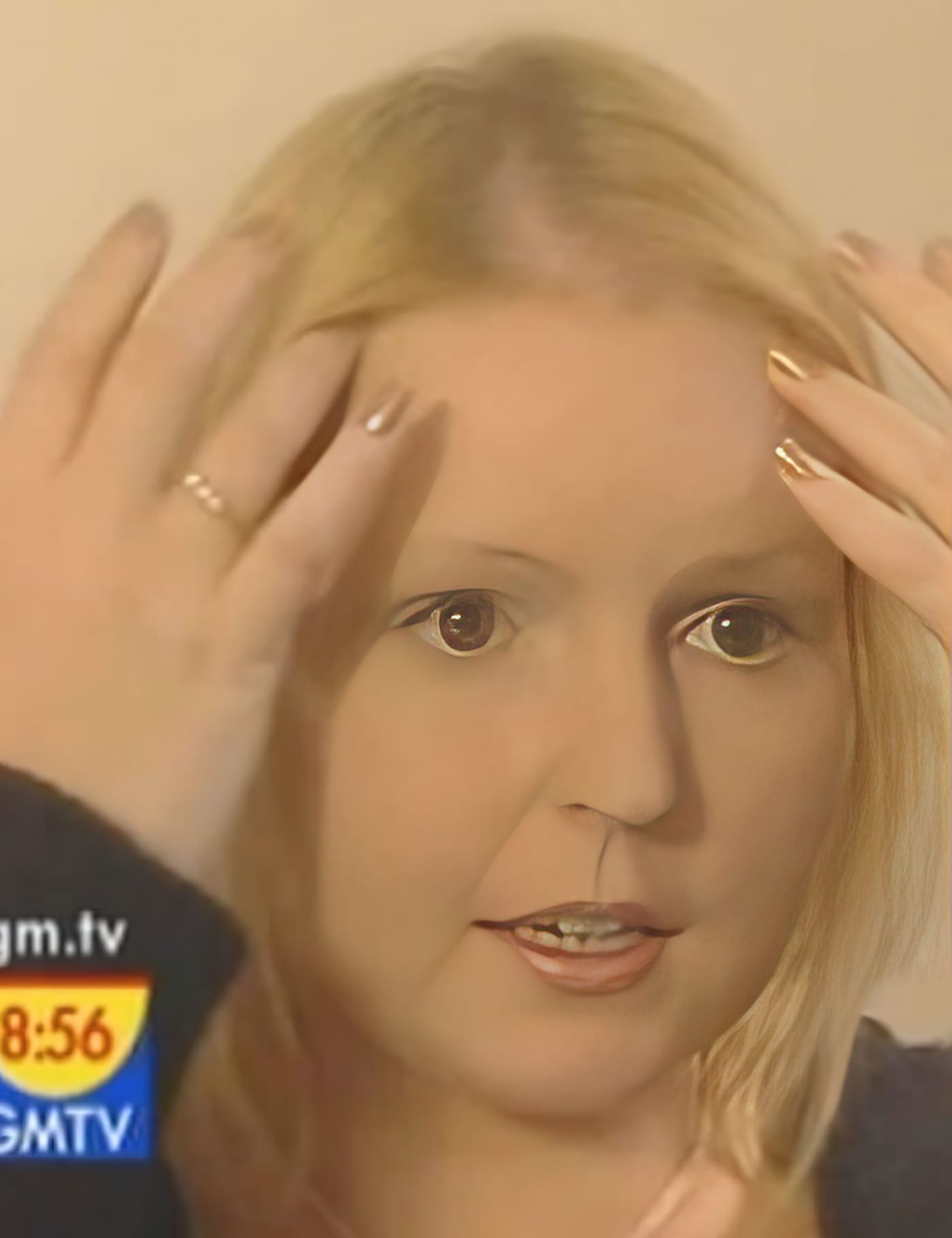 Before Picture - Endometriosis Hair Loss Miracle Makeover - TV