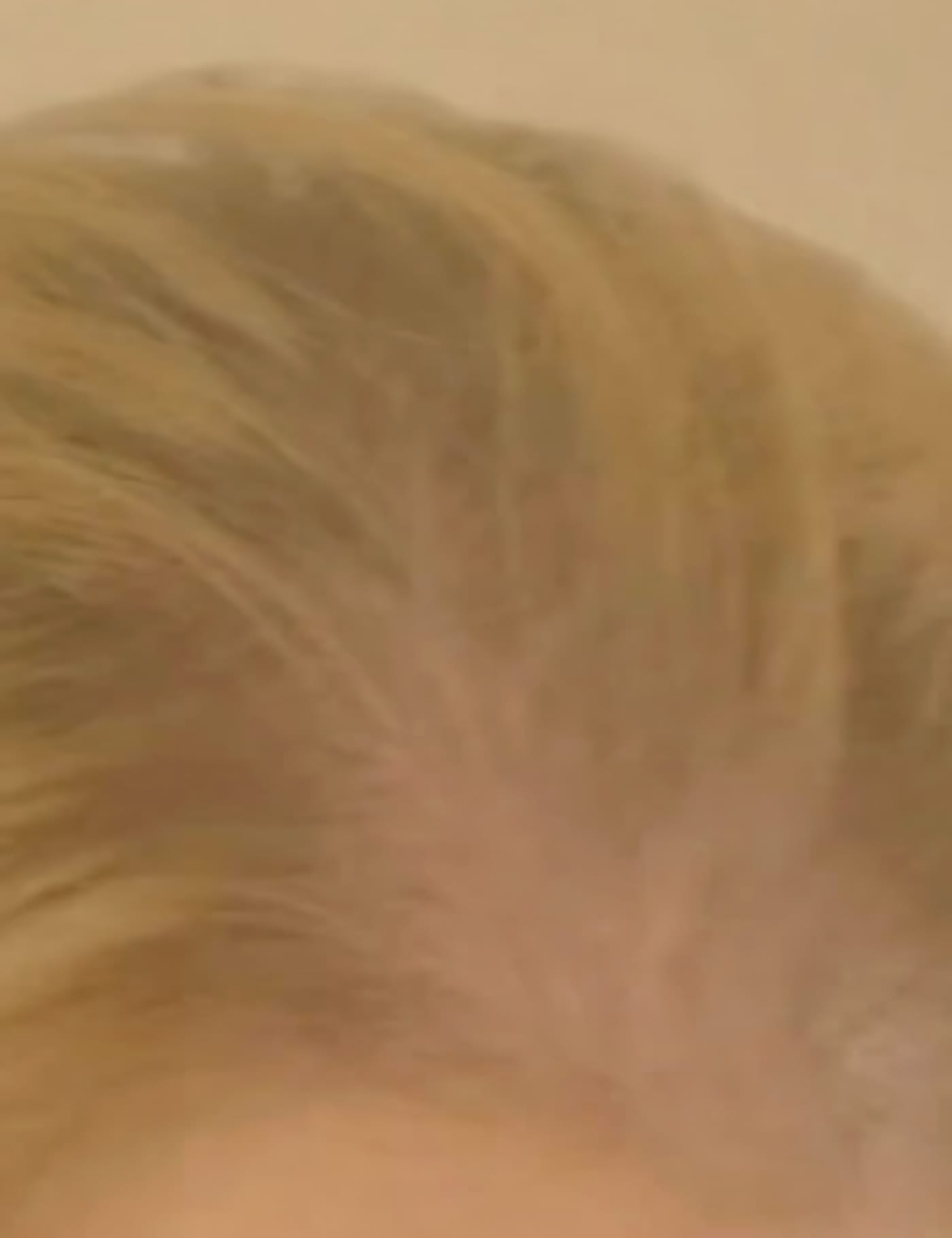 Before Picture - Endometriosis Hair Loss Miracle Makeover - TV