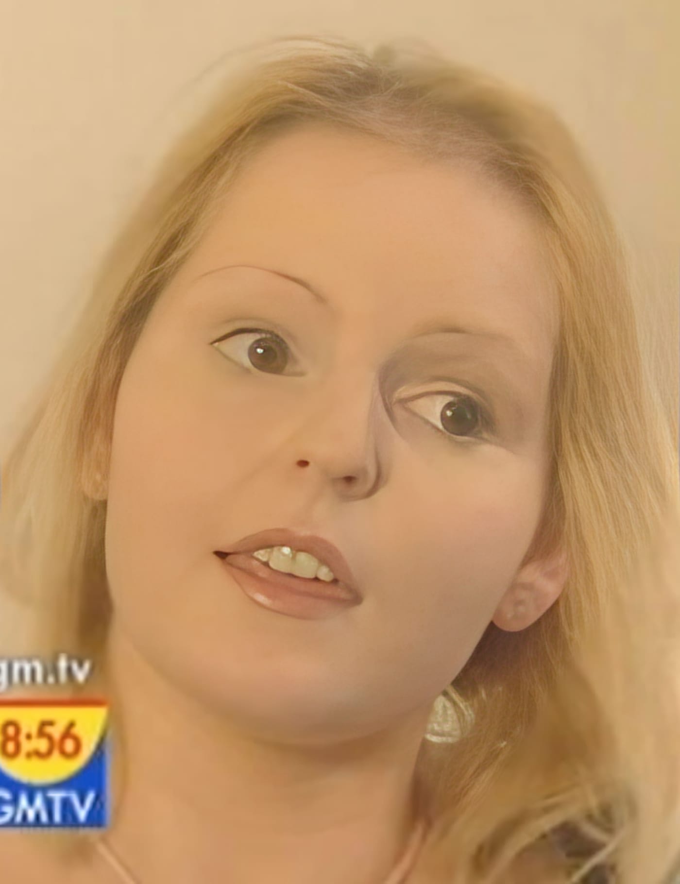 Before Picture - Endometriosis Hair Loss Miracle Makeover - TV