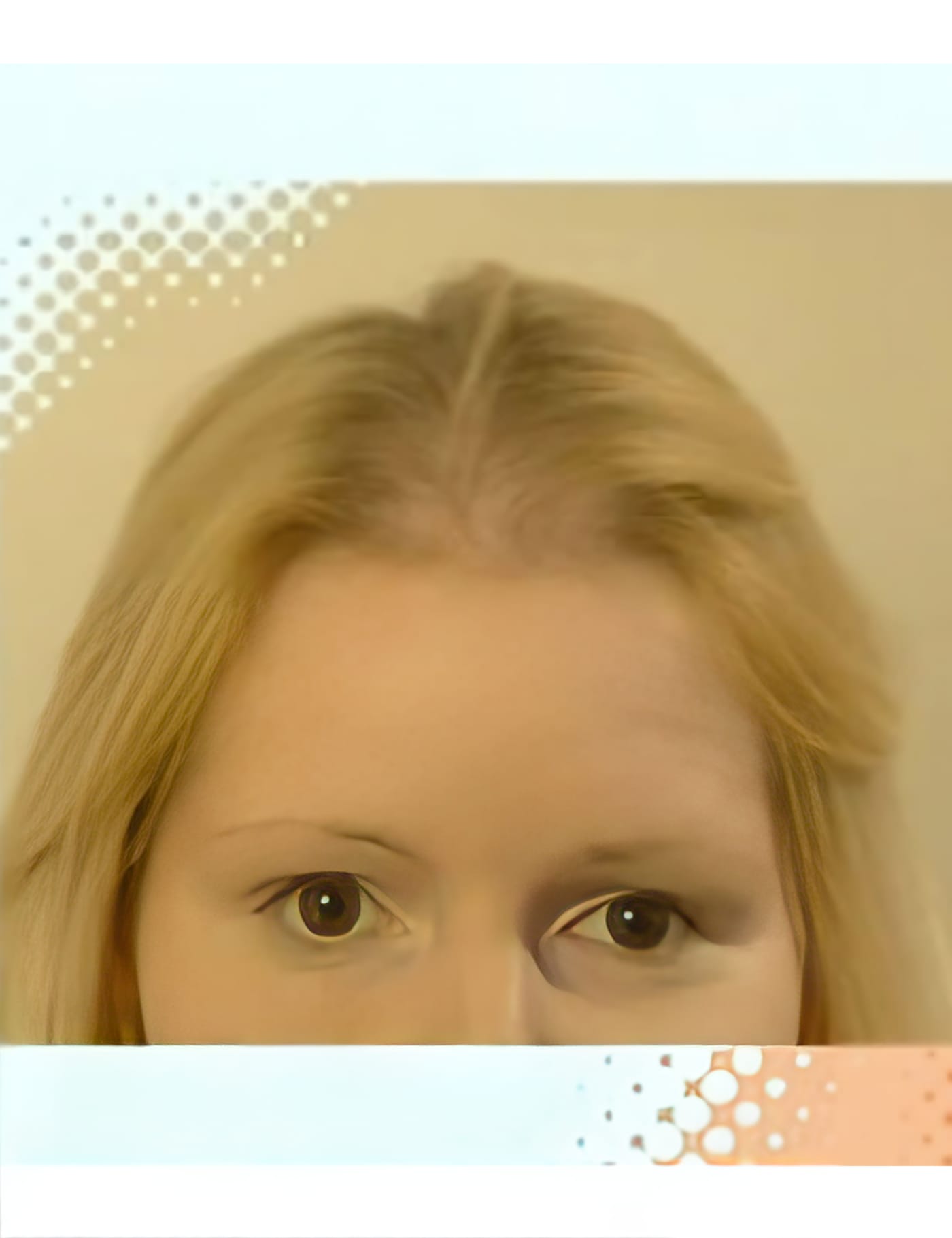 Before Picture - Endometriosis Hair Loss Miracle Makeover - TV
