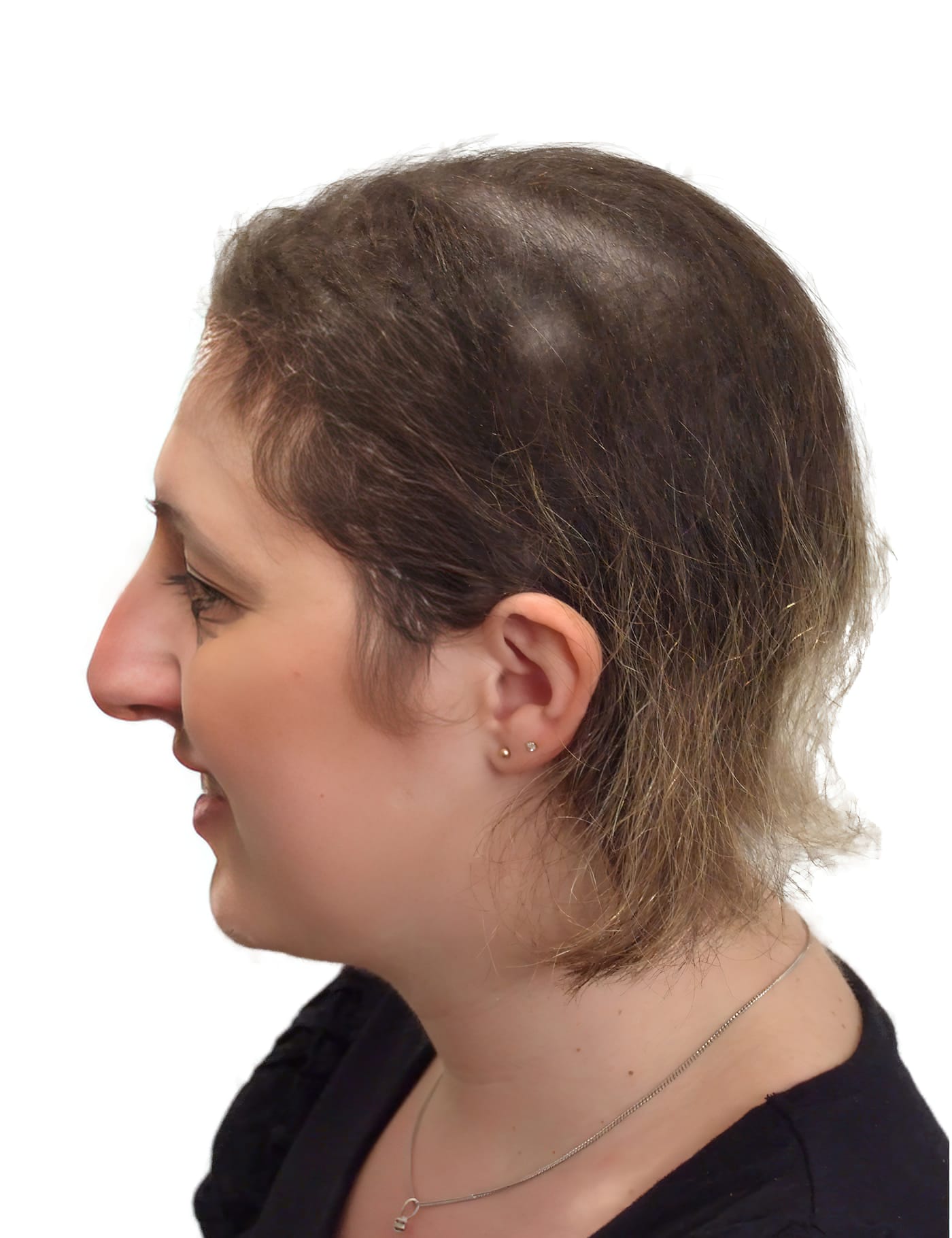 Before Picture - Leukaemia Hair Loss Restored for Wedding
