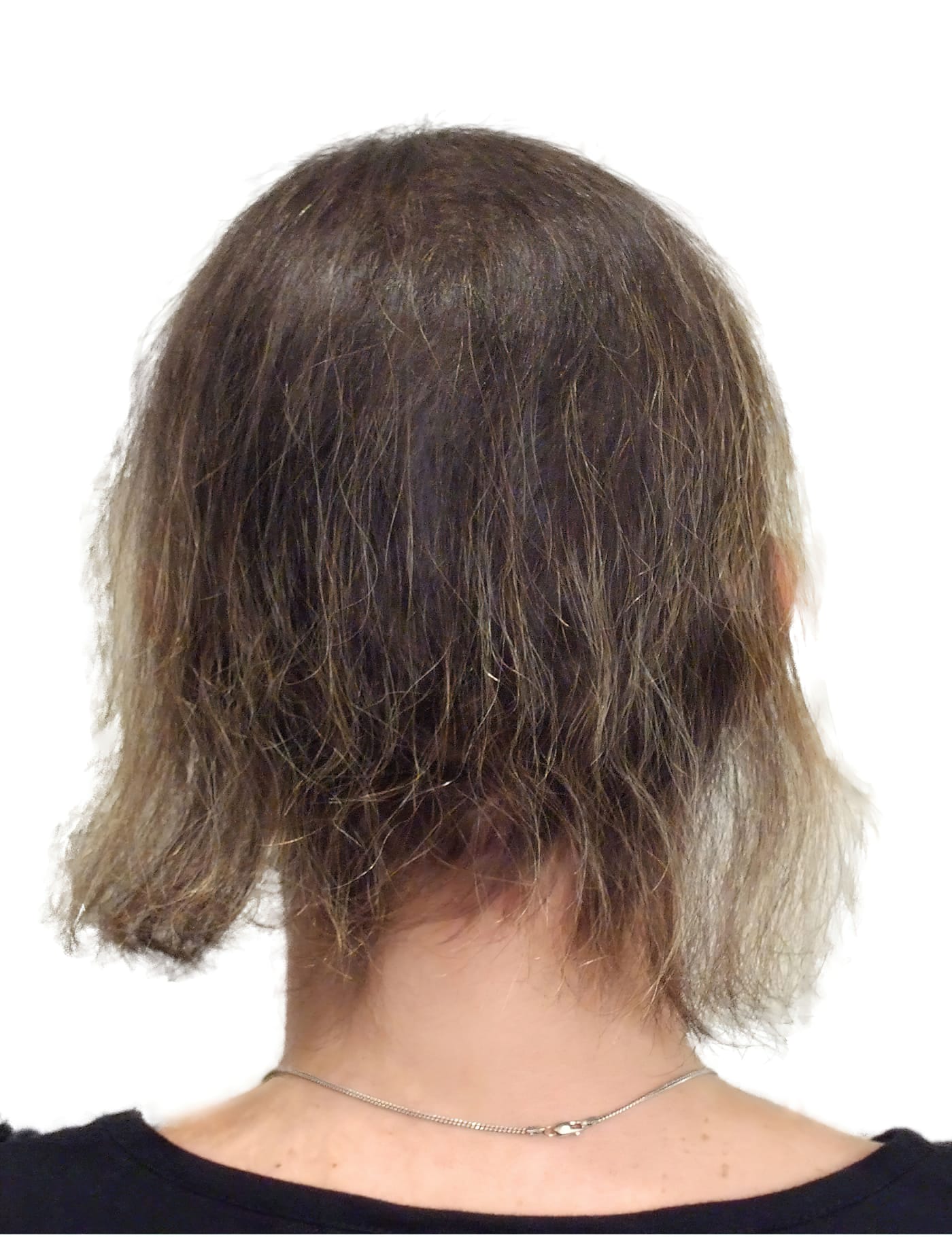 Before Picture - Leukaemia Hair Loss Restored for Wedding