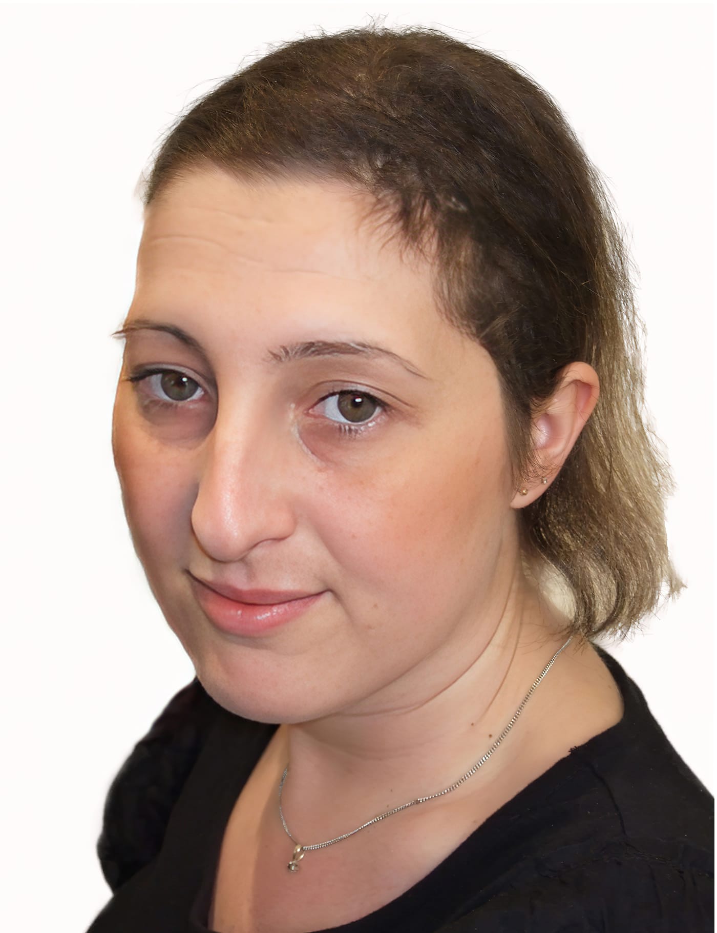 Before Picture - Leukaemia Hair Loss Restored for Wedding
