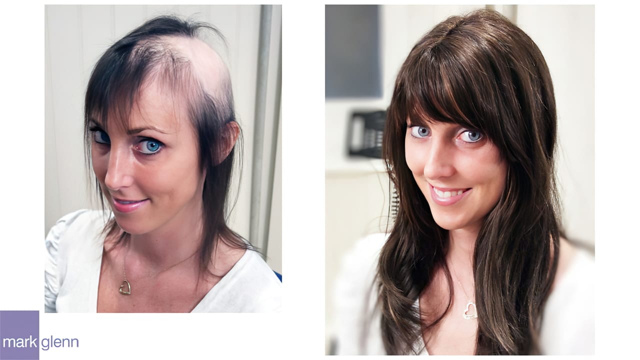 HL110 - Radiotherapy & Surgery Hair Loss - Before & After - Mark Glenn, London