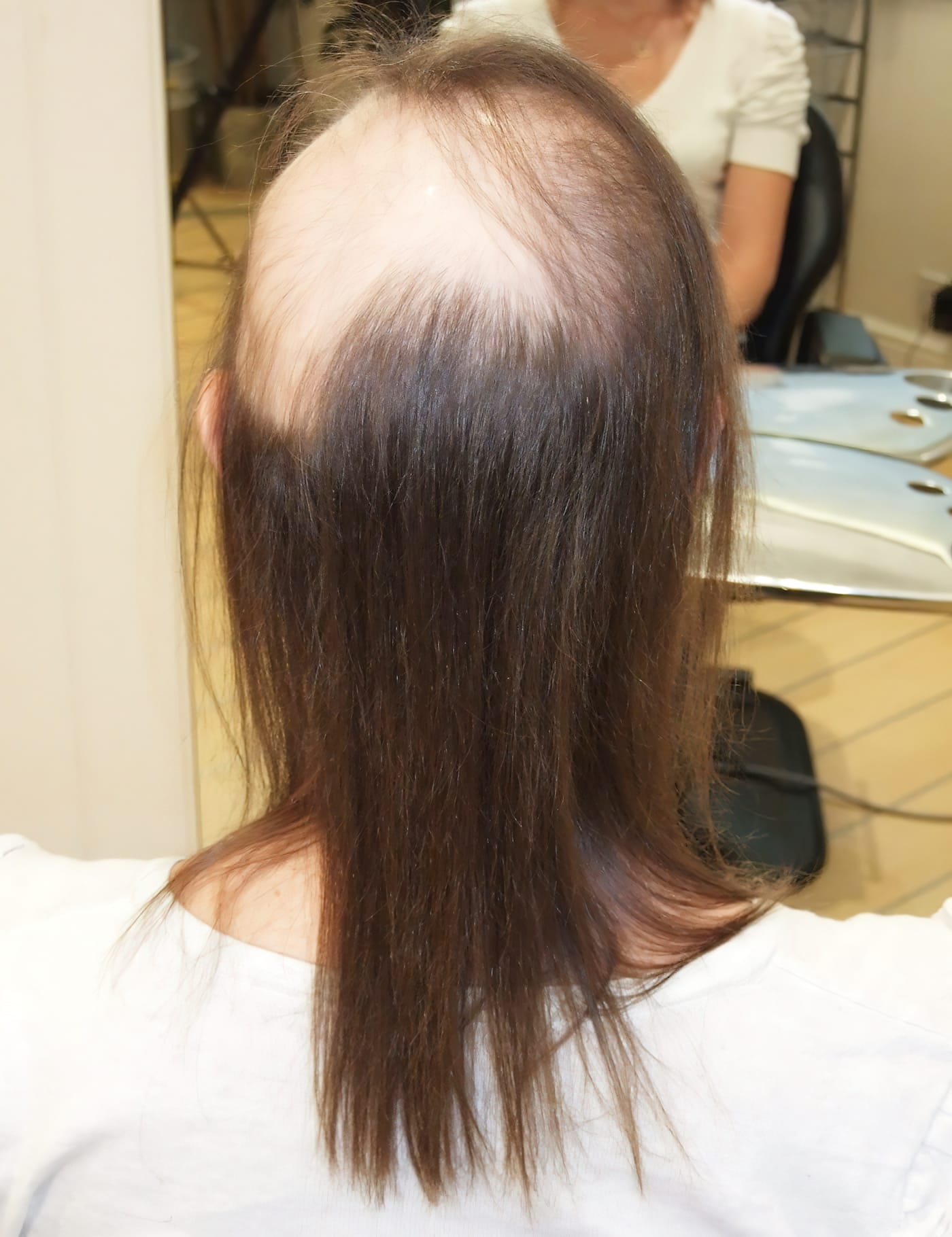 Before Picture - Radiotherapy & Surgery Hair Loss - No More Wigs
