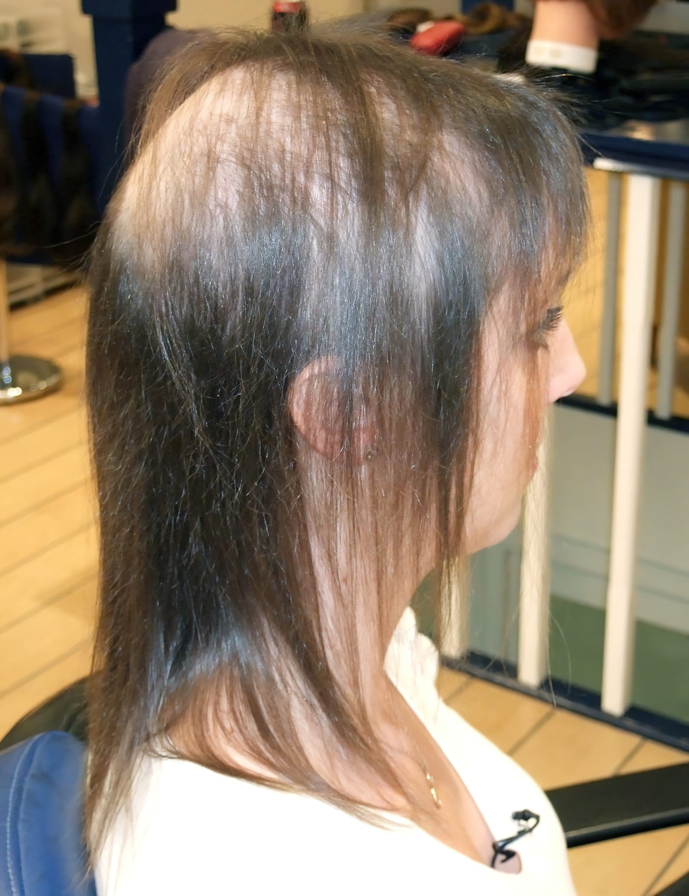 Before Picture - Radiotherapy & Surgery Hair Loss - No More Wigs