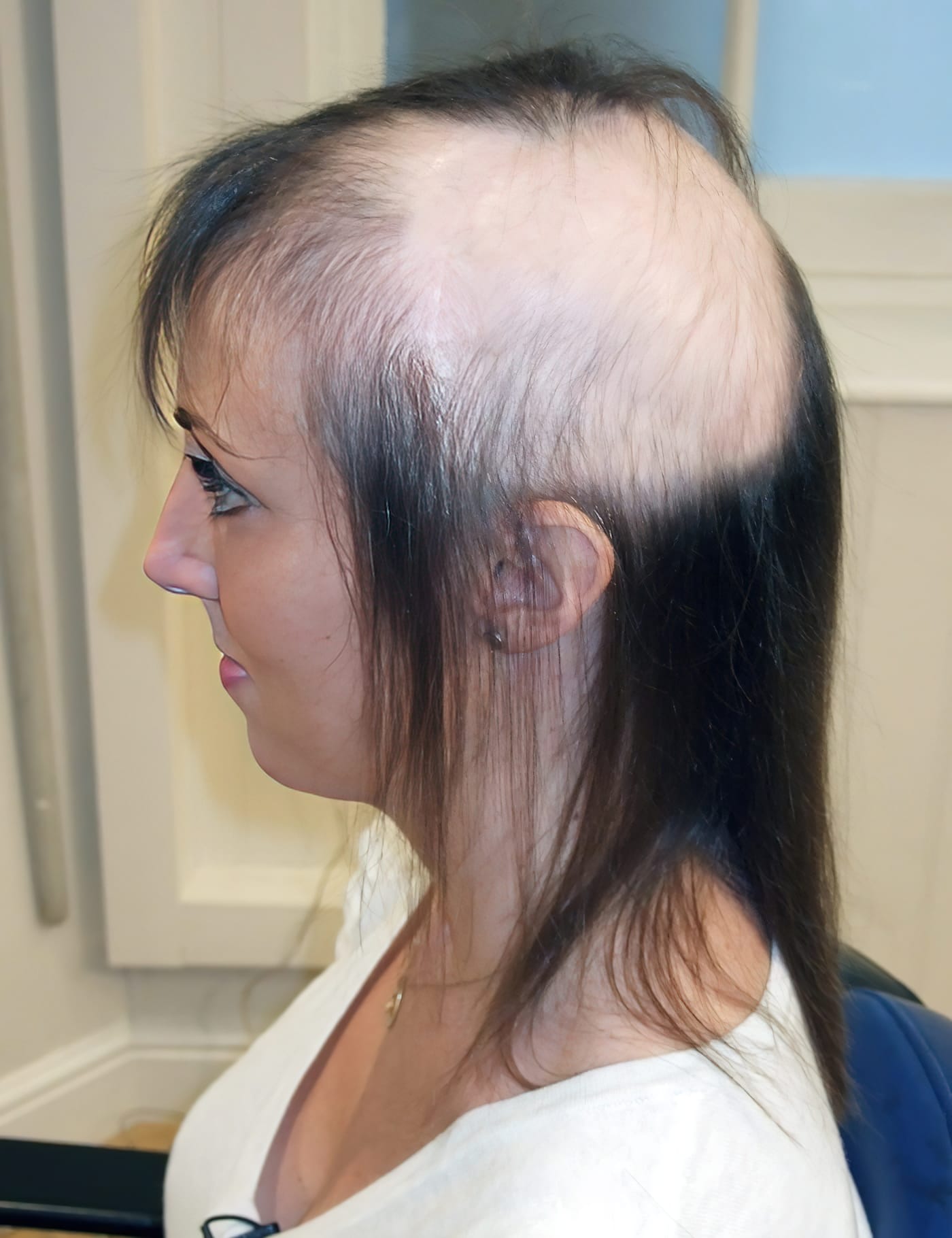 Before Picture - Radiotherapy & Surgery Hair Loss - No More Wigs