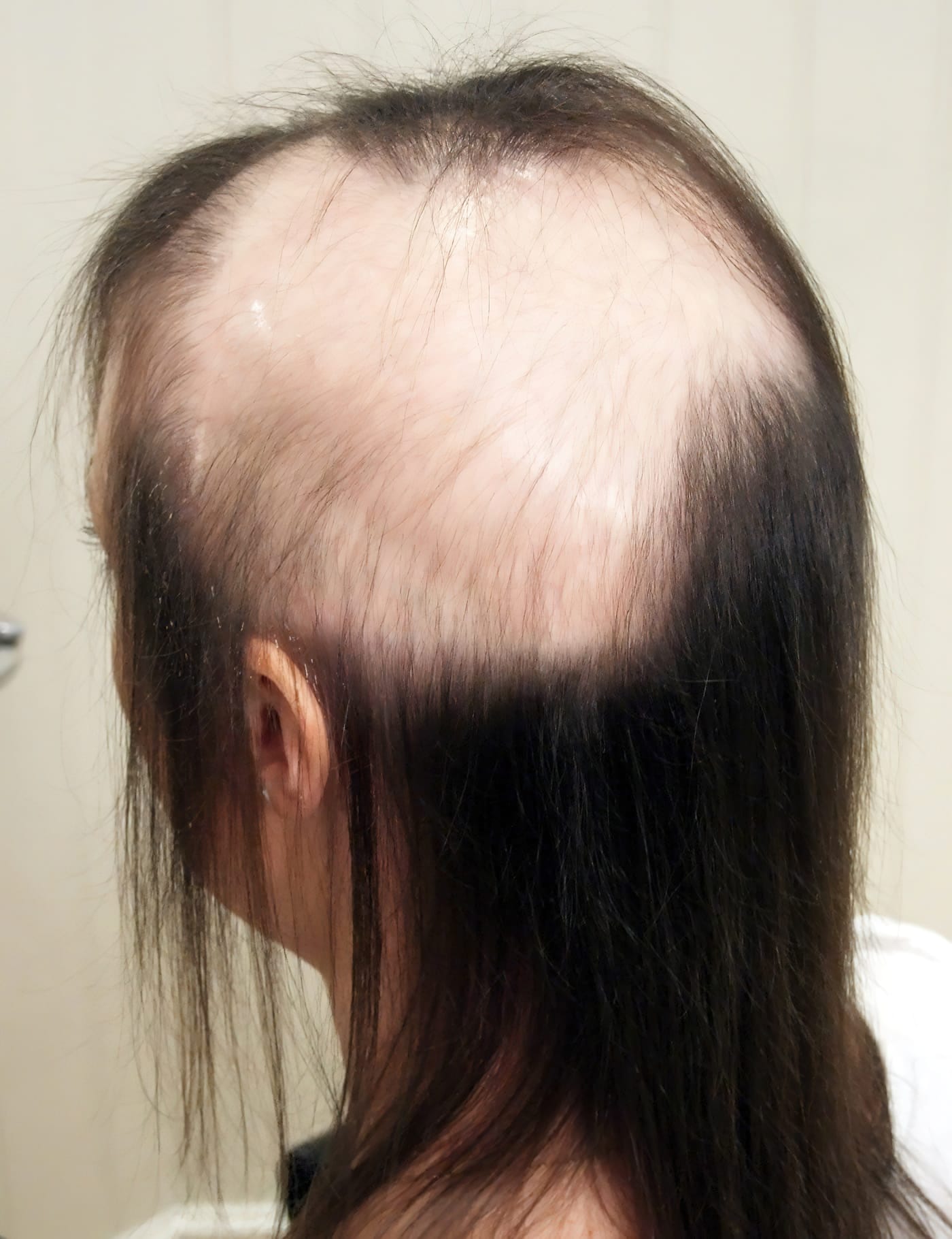 Before Picture - Radiotherapy & Surgery Hair Loss - No More Wigs