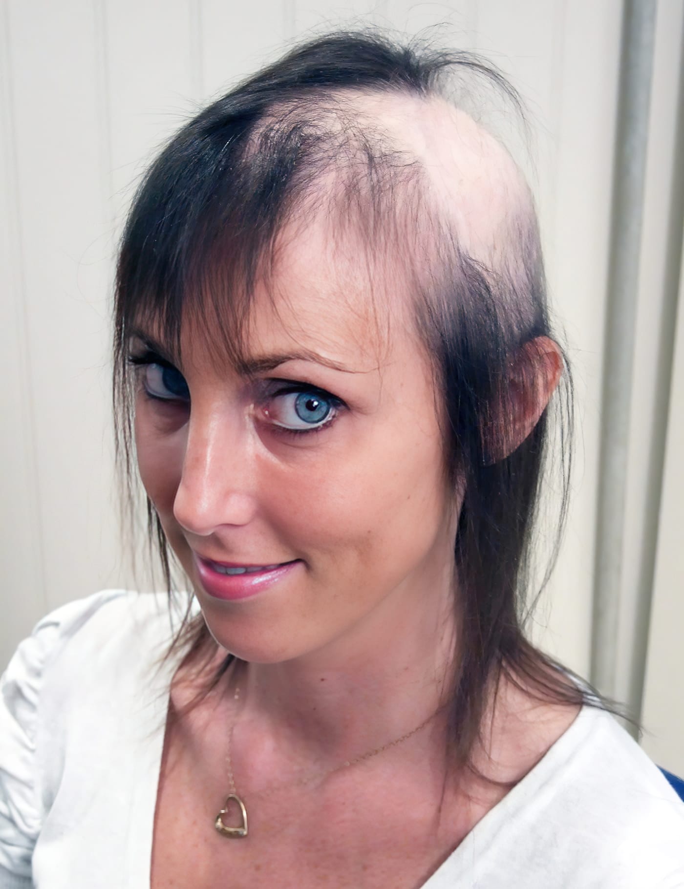 Before Picture - Radiotherapy & Surgery Hair Loss - No More Wigs