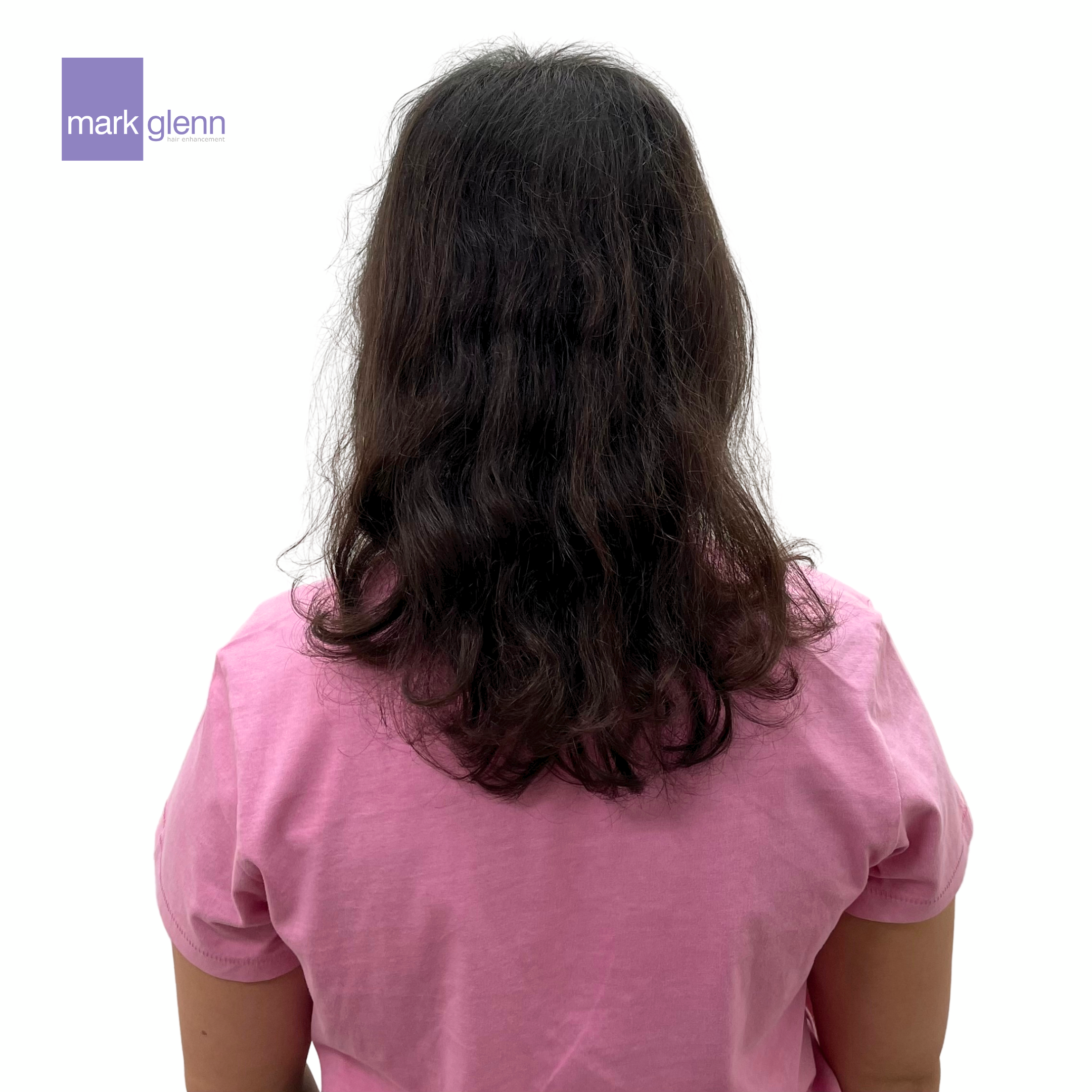 Before Picture - Contraceptive Pill Hair Loss Restoration