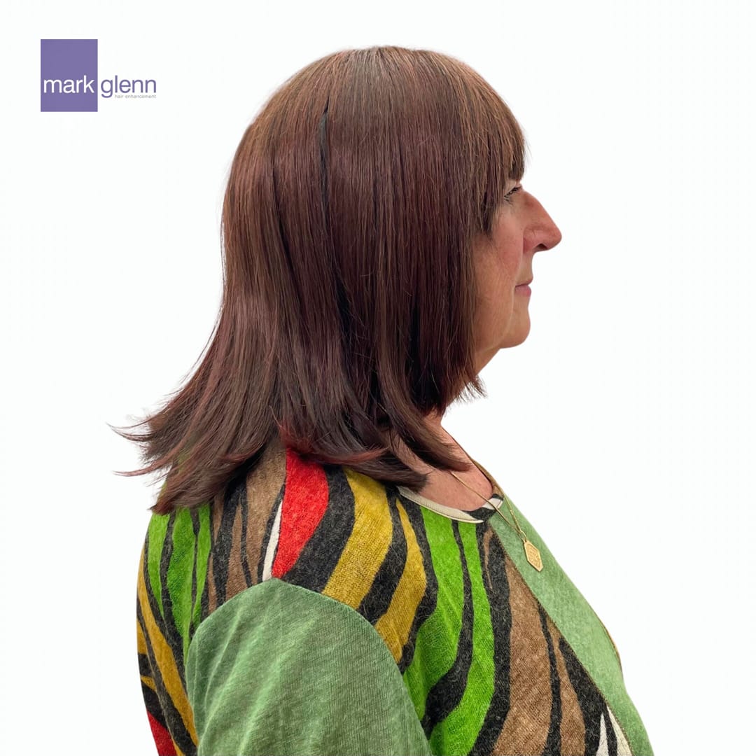 After Picture - Cancer Chemotherapy Permanent Hair Loss Transformation